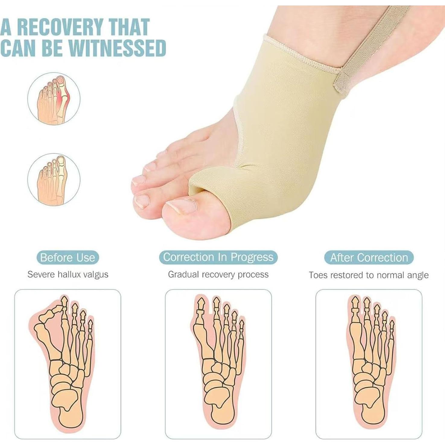 Corrector de Juanetes XILEAN 2PCS Ajustable Unisex Negro