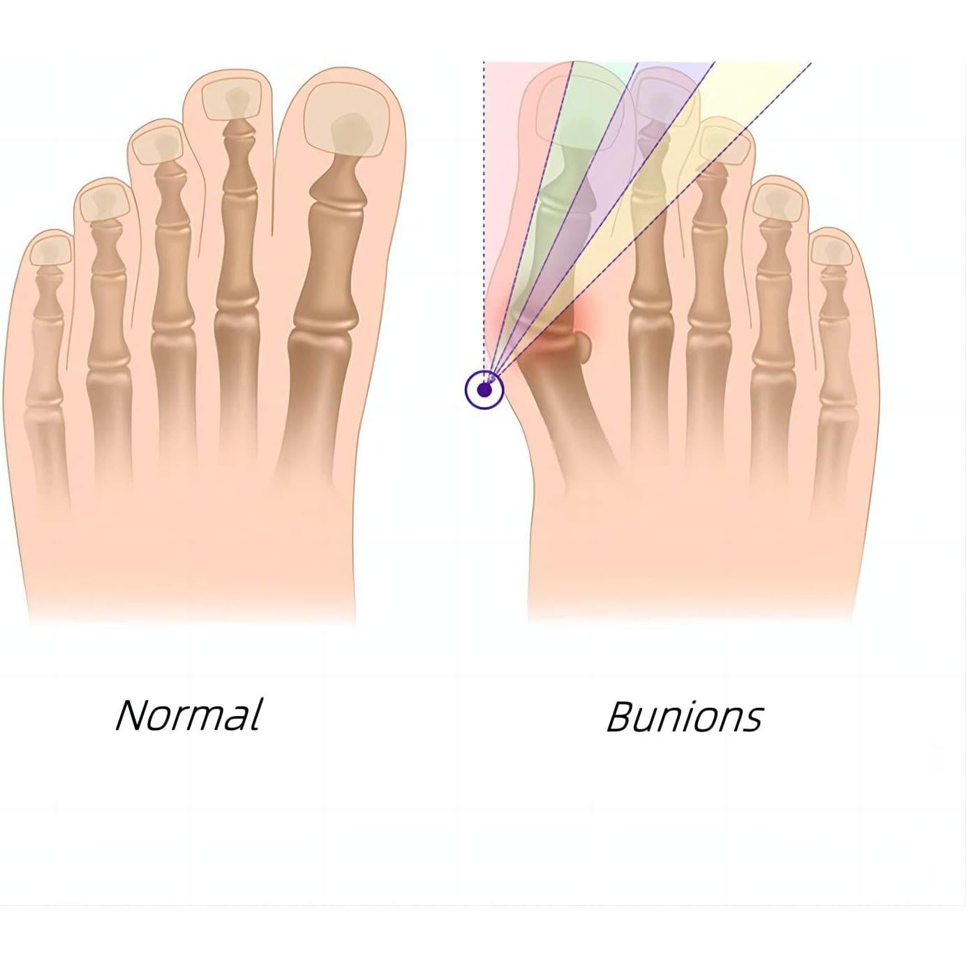 Corrector de Juanetes KAEZDD con Almohadillas de Gel - Talla S