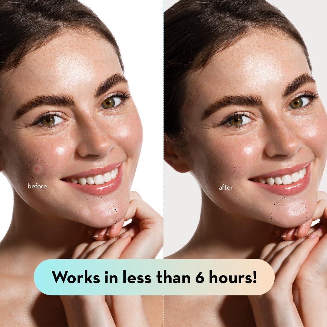 Parche Hidrocoloide LE GUSHE 132 Puntos para Espinillas