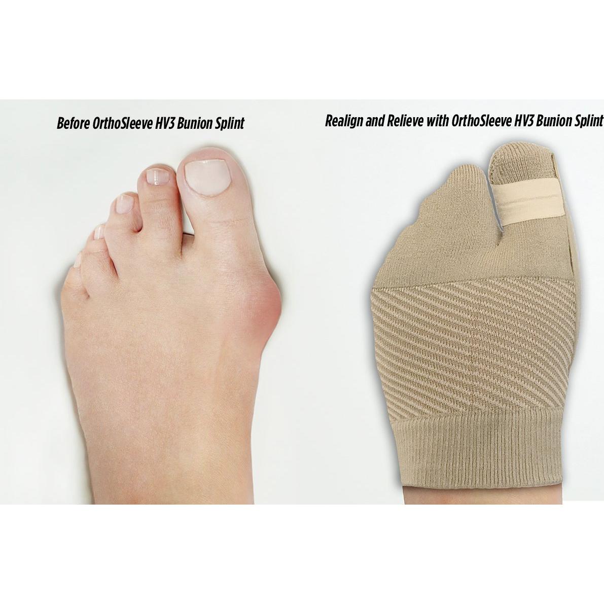 Férula para Juanetes OrthoSleeve HV3 - Alivio Hallux Valgus S/M