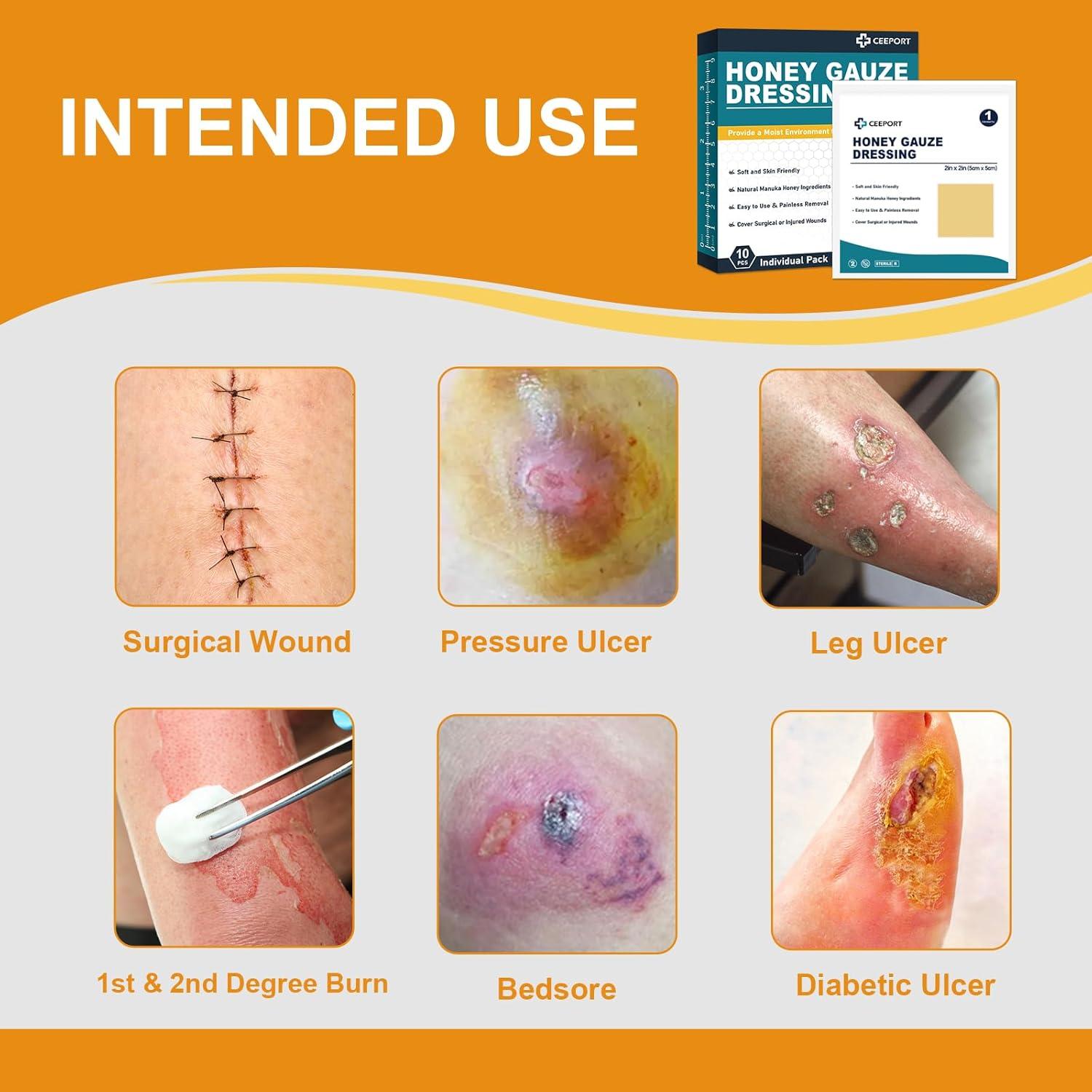 Venda de Herida de Miel de Manuka Ceeport 5.08 cm x 5.08 cm - 10 Piezas