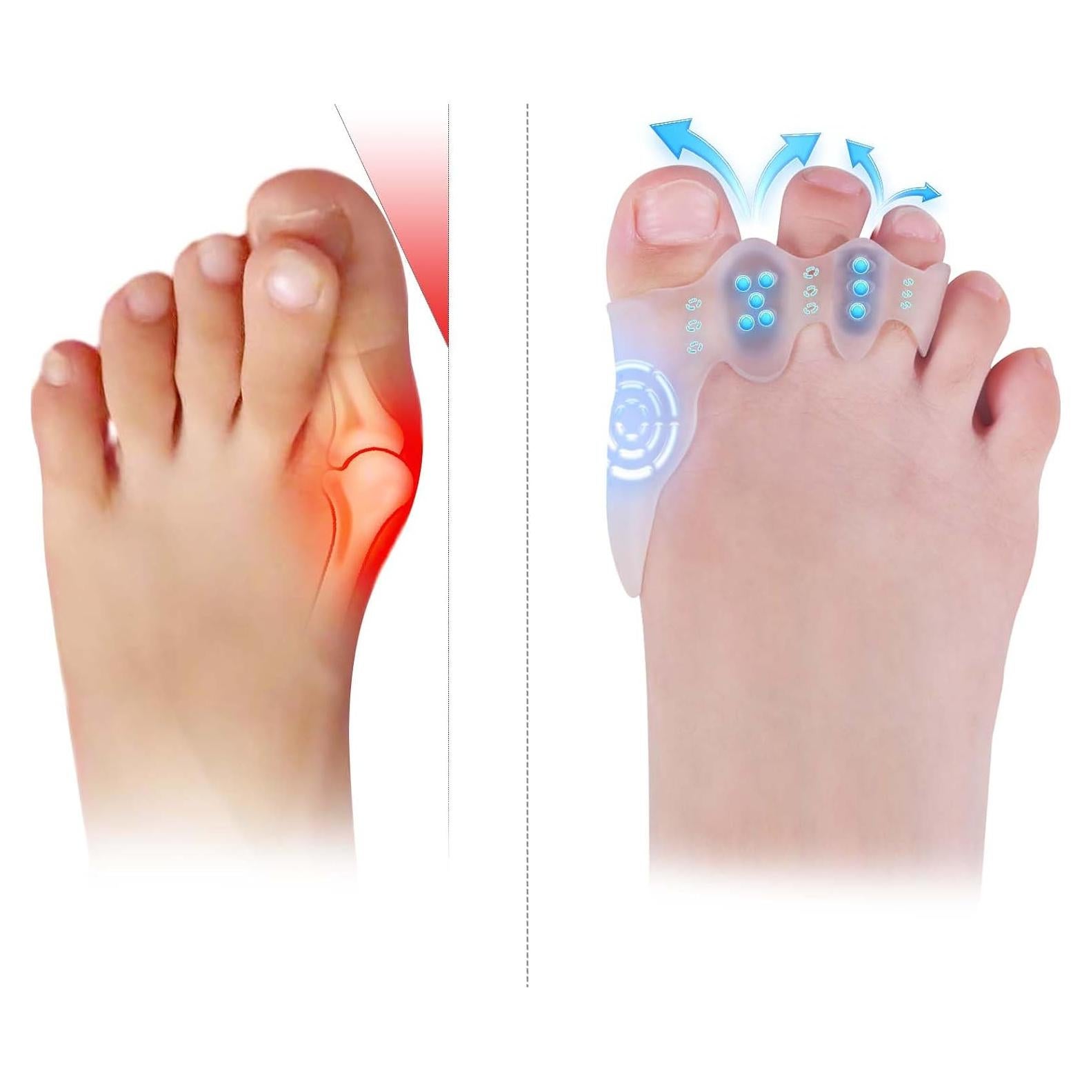 Separadores de Dedos TEVEZO para Niños - Corrector de Juanetes