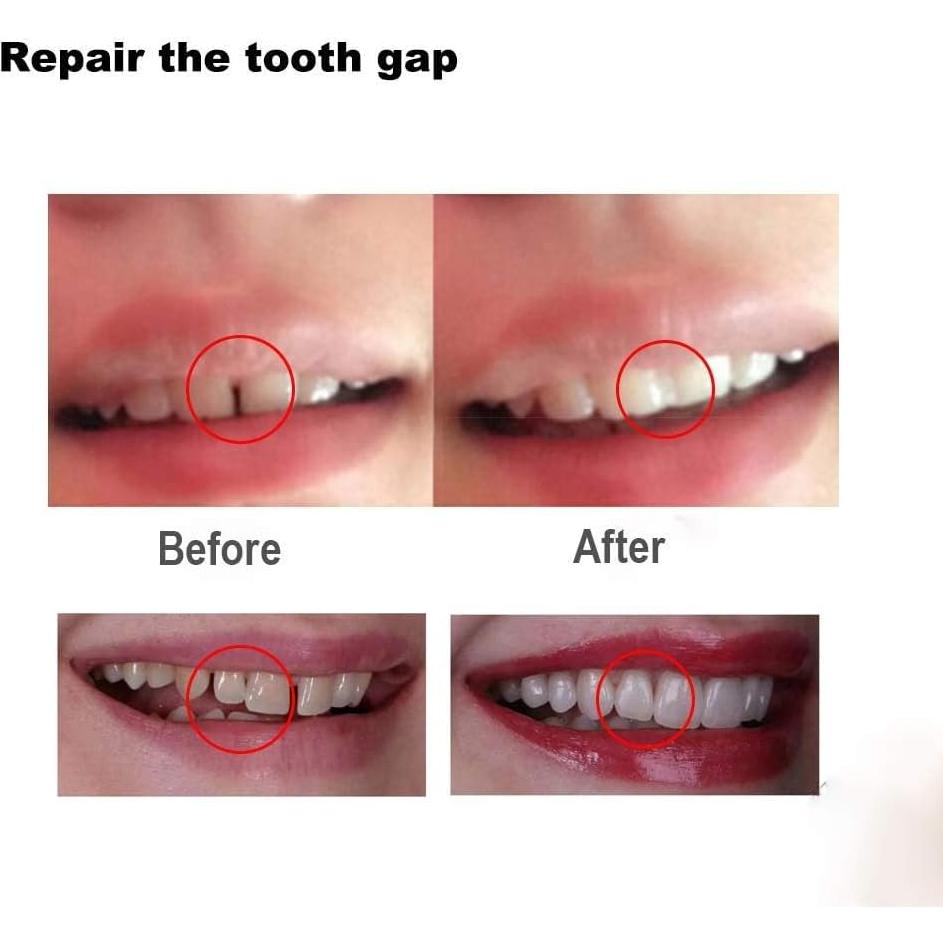 Perlas Térmicas Brige para Relleno Dental - 1000 Perlas