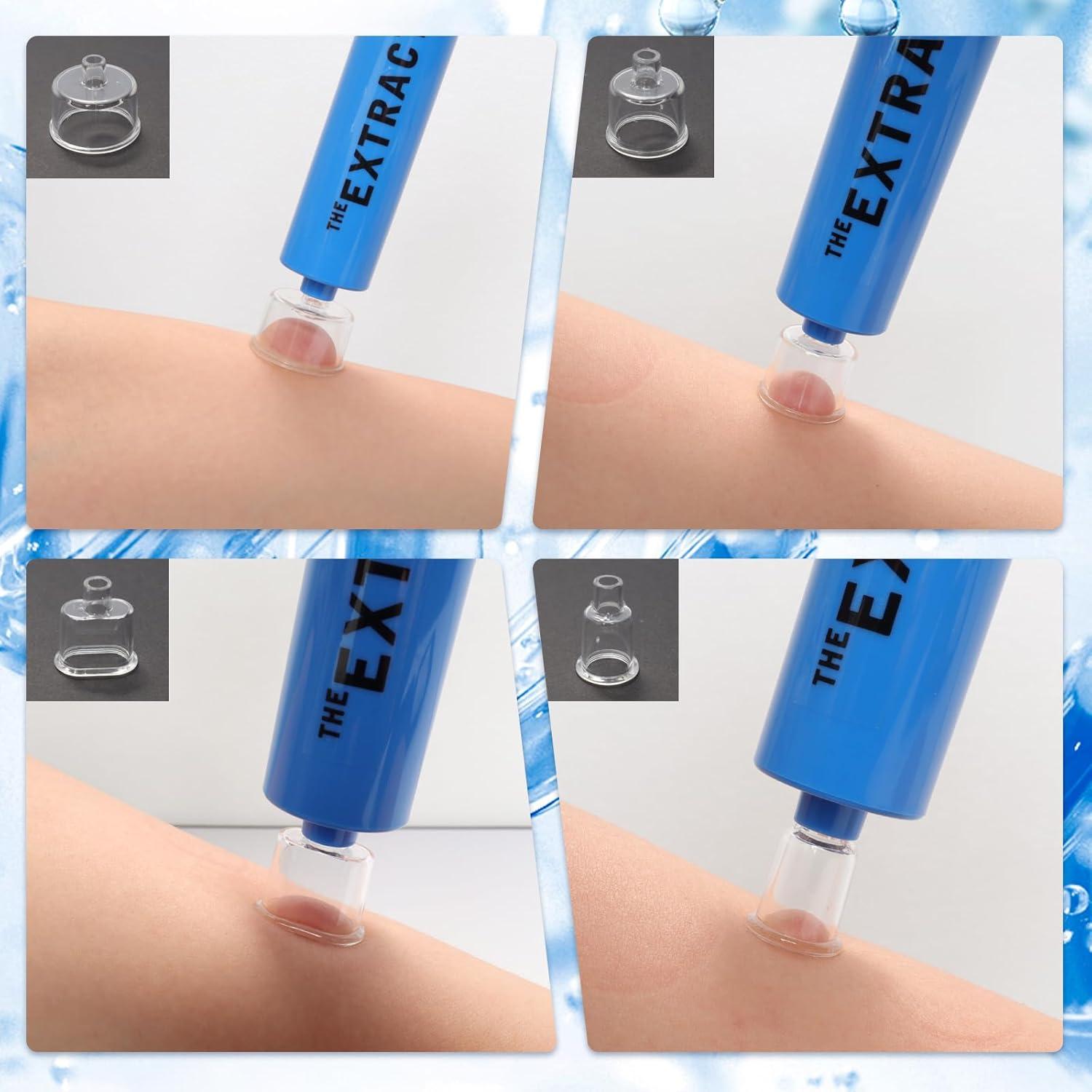 Kit de Emergencia para Picaduras Gvhntk - Extractor de Veneno