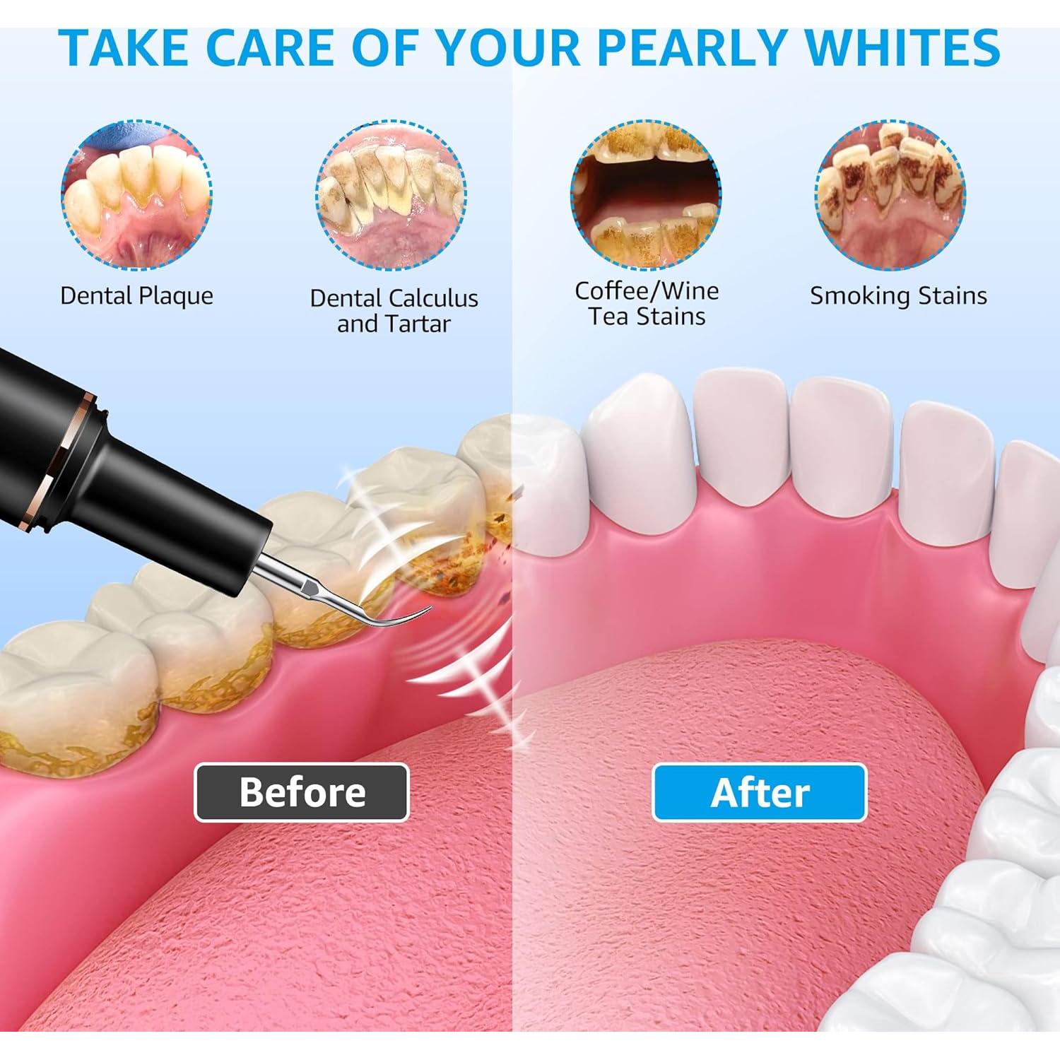 Removedor de Placa Dental TANAVE T9 con Limpiador Ultrasónico y LED