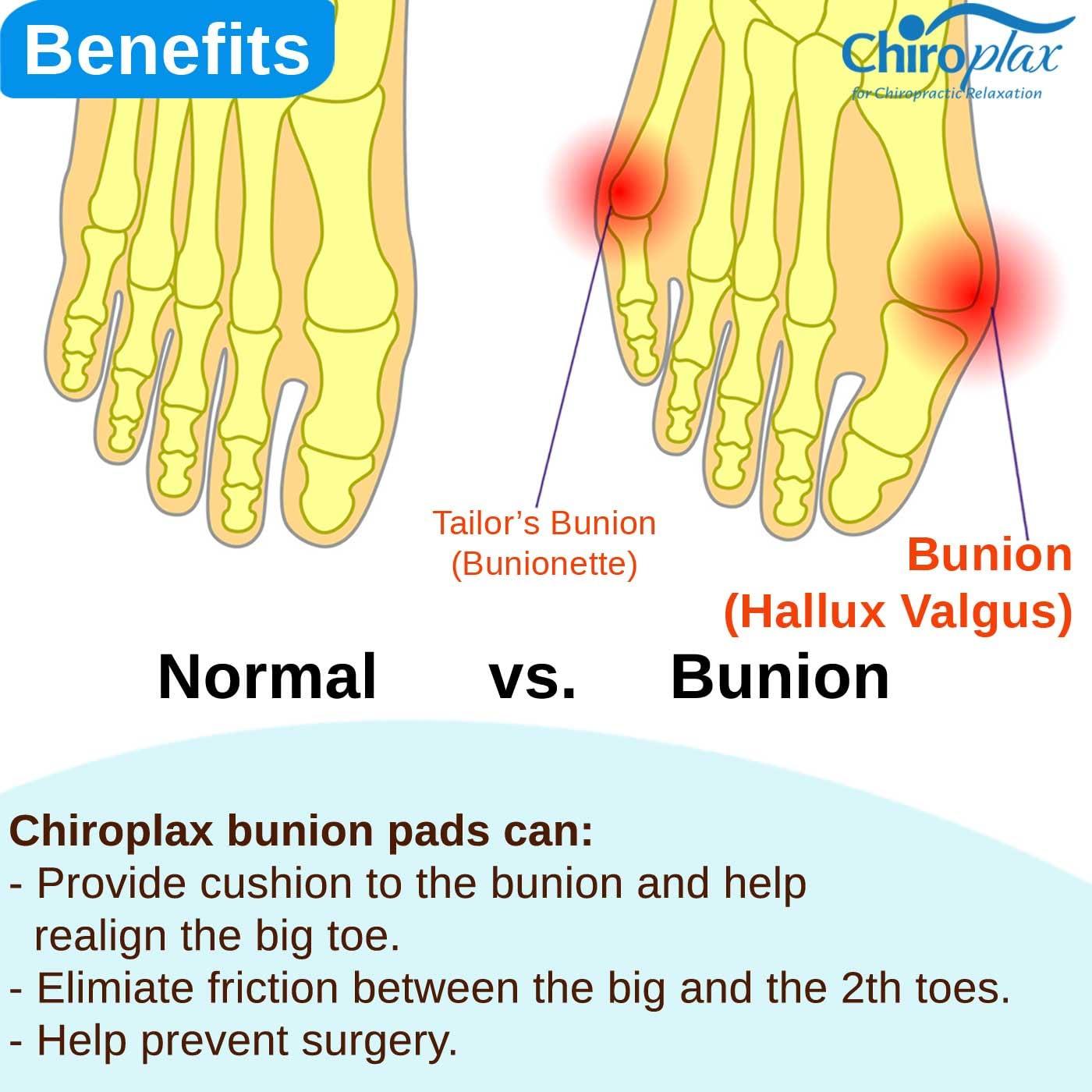 Corrector de Juanetes Chiroplax - Almohadillas de Gel Suave