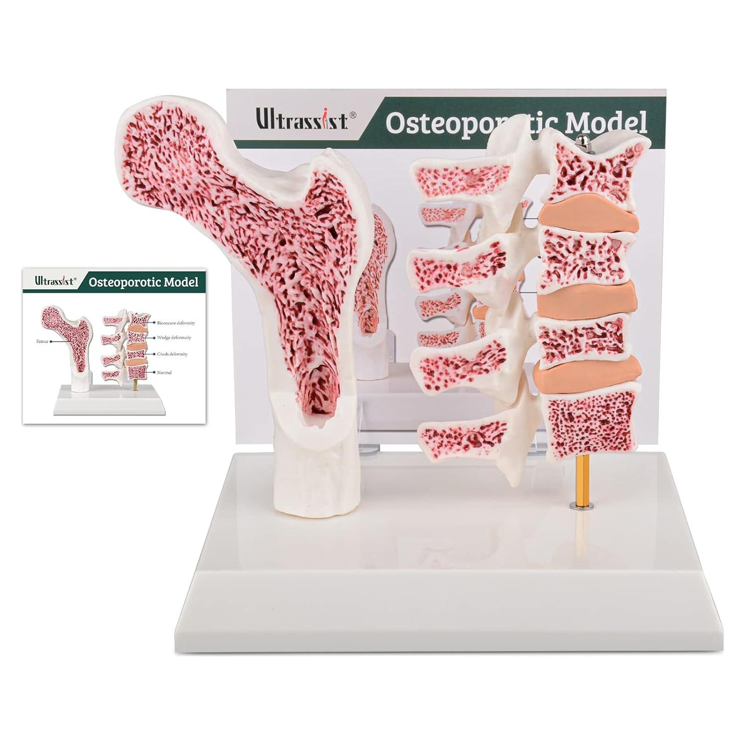 Modelo de Anatomía Humana Osteoporosis Ultrassist 20x20cm
