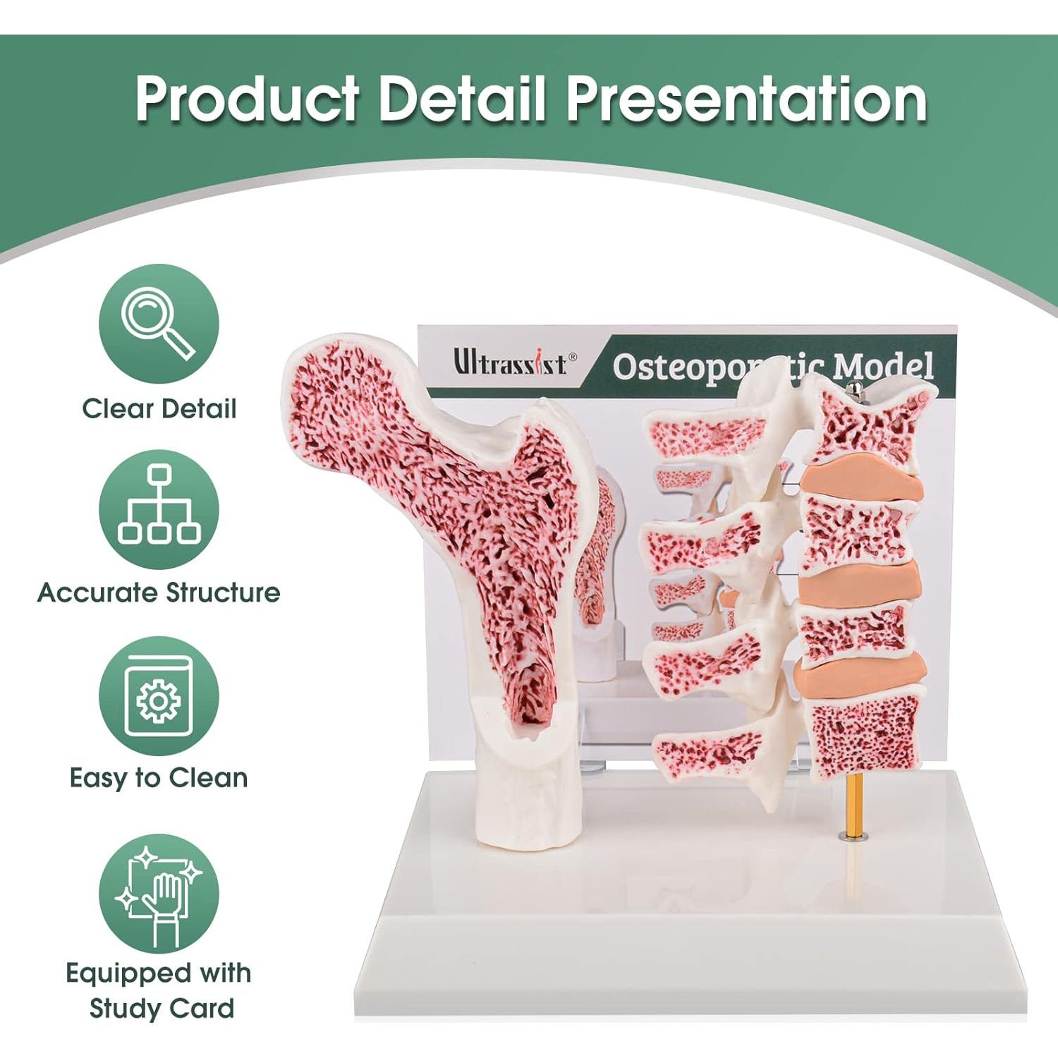 Modelo de Anatomía Humana Osteoporosis Ultrassist 20x20cm