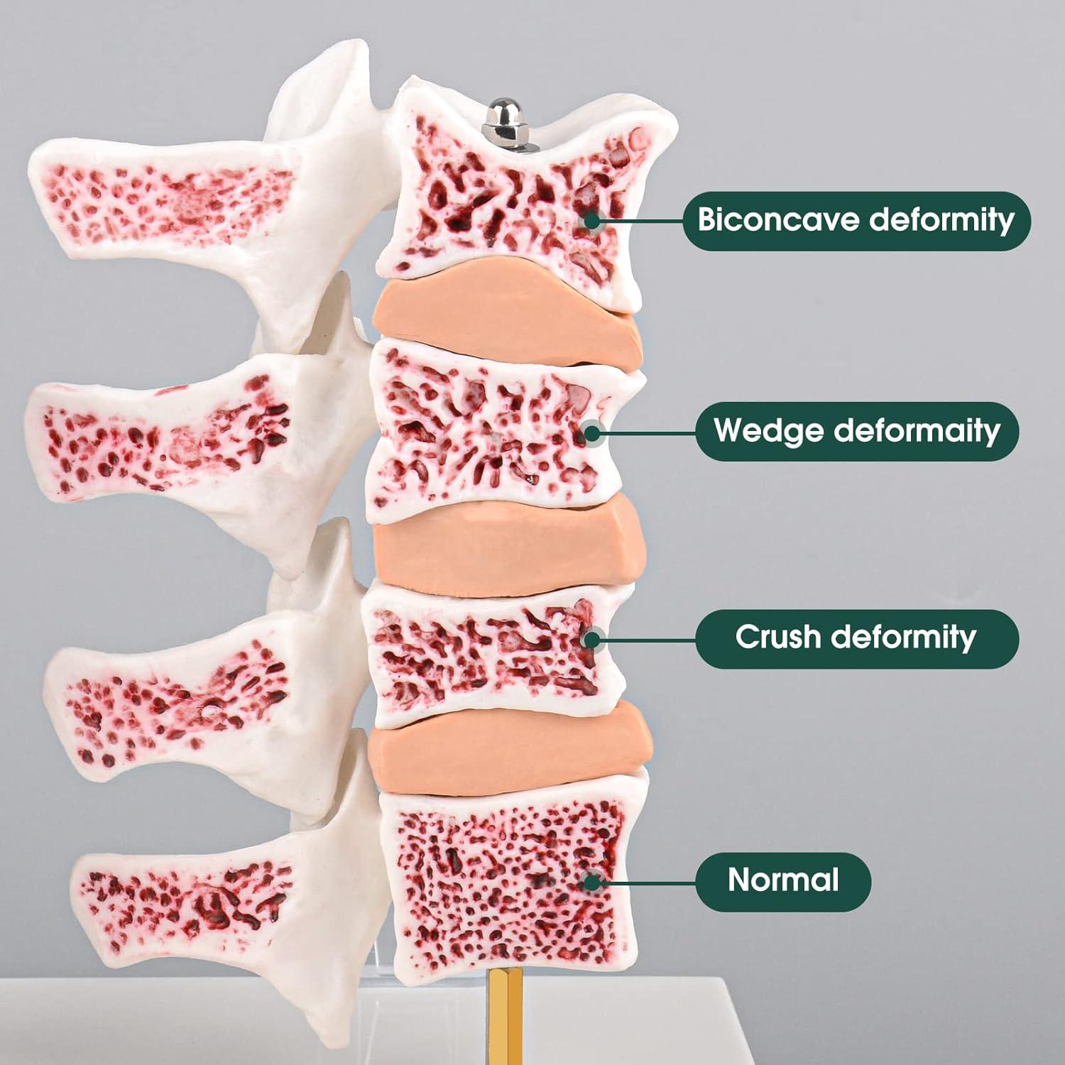 Modelo de Anatomía Humana Osteoporosis Ultrassist 20x20cm
