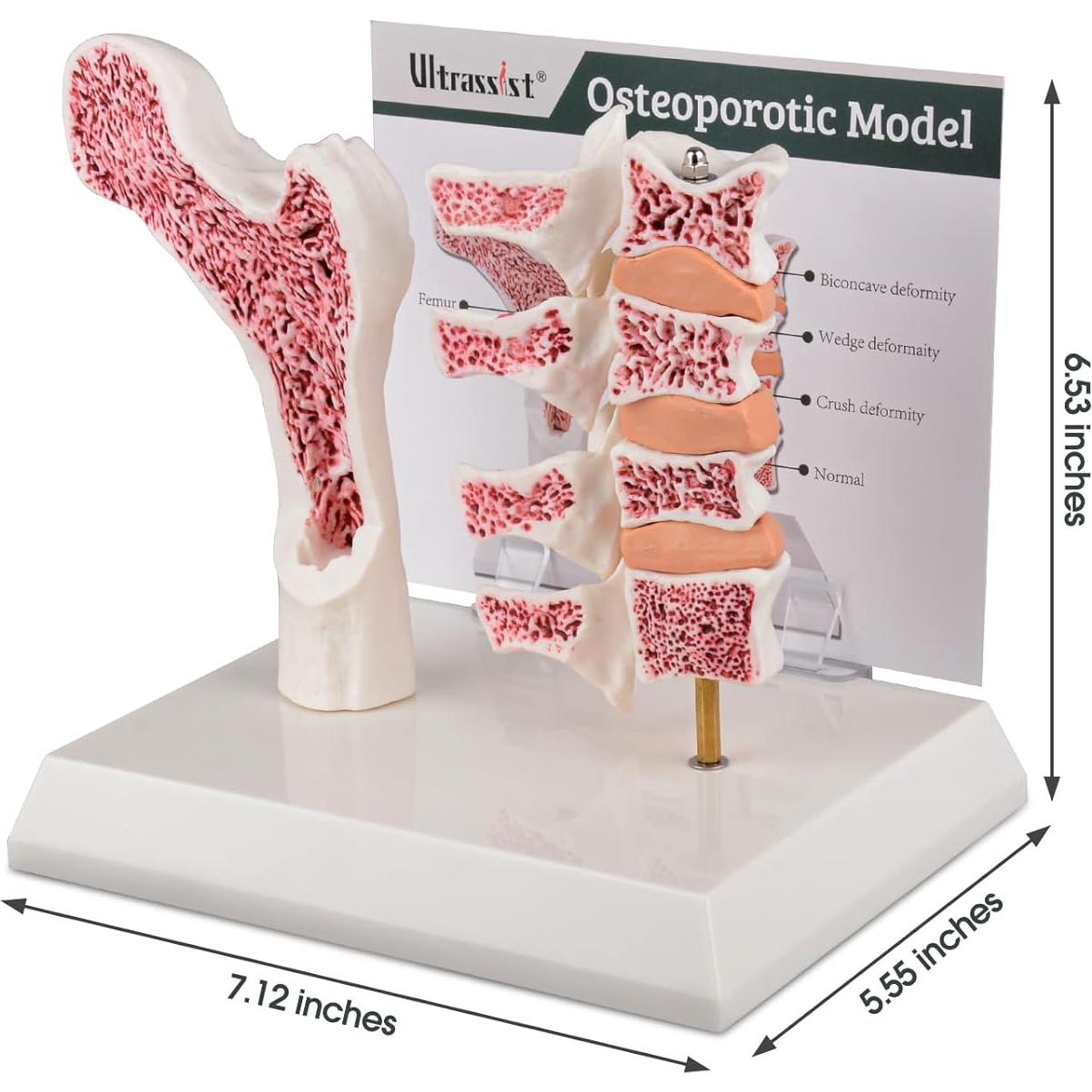 Modelo de Anatomía Humana Osteoporosis Ultrassist 20x20cm