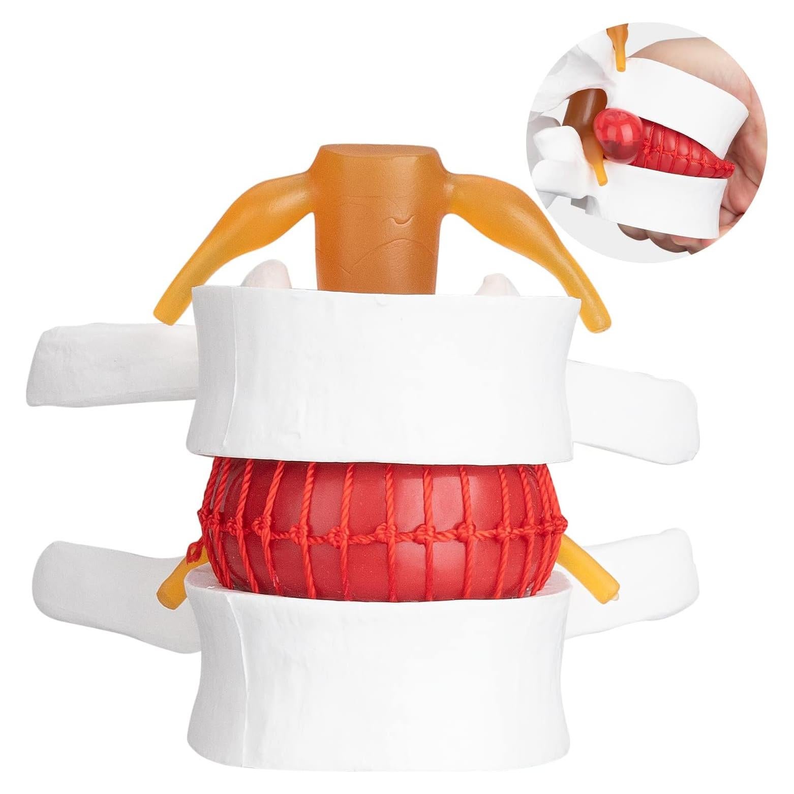 Modelo Anatómico de Hernia de Disco Lumbar Healthible - PVC 1.5X