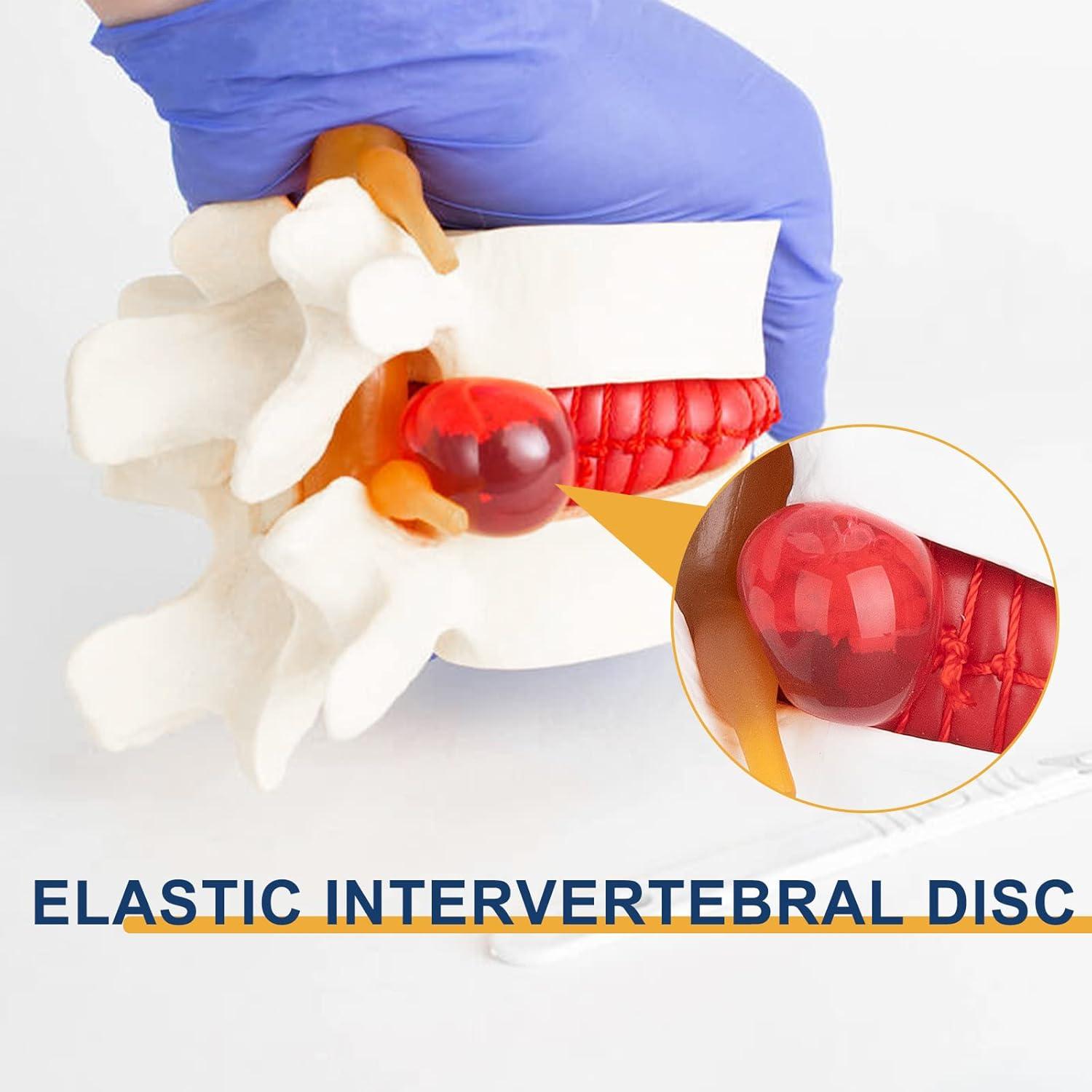 Modelo Anatómico de Hernia de Disco Lumbar Healthible - PVC 1.5X