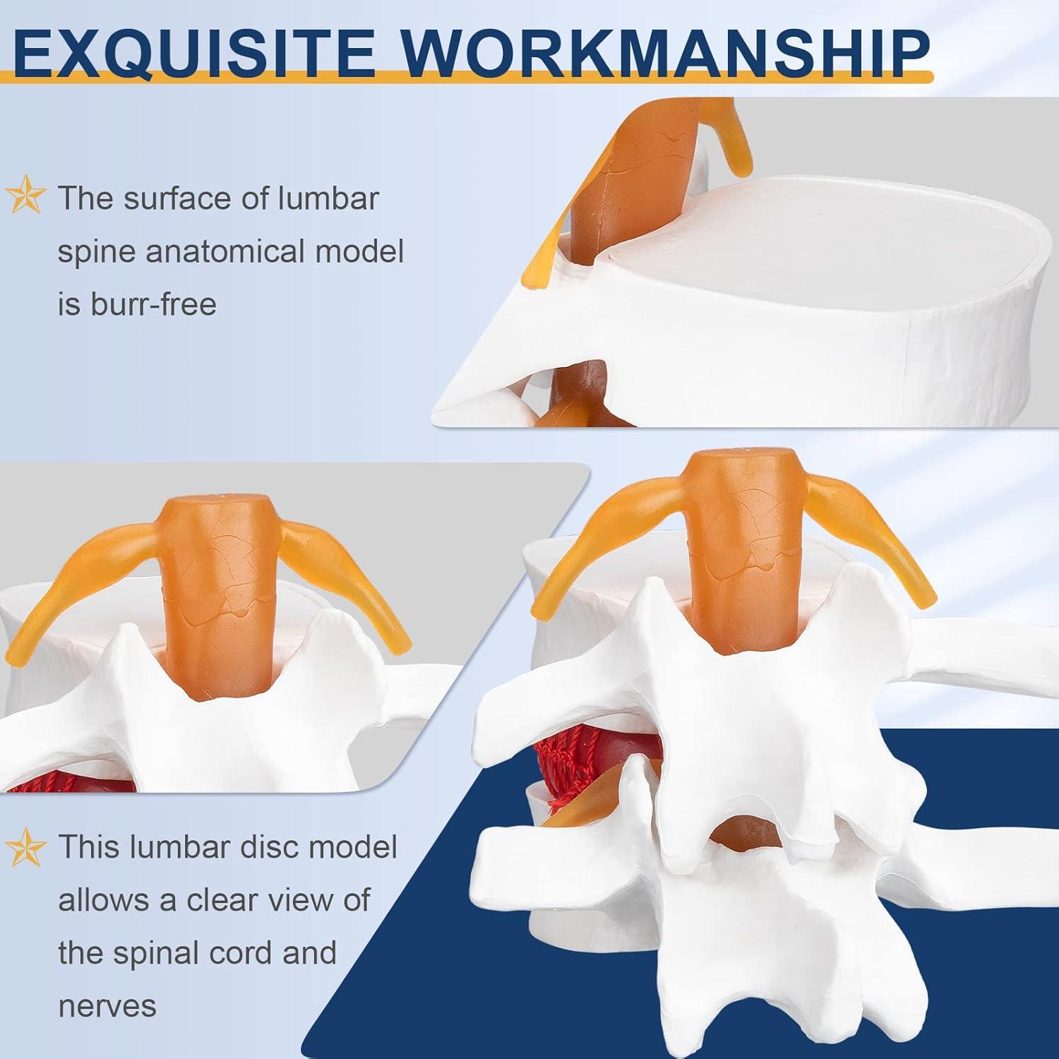 Modelo Anatómico de Hernia de Disco Lumbar Healthible - PVC 1.5X