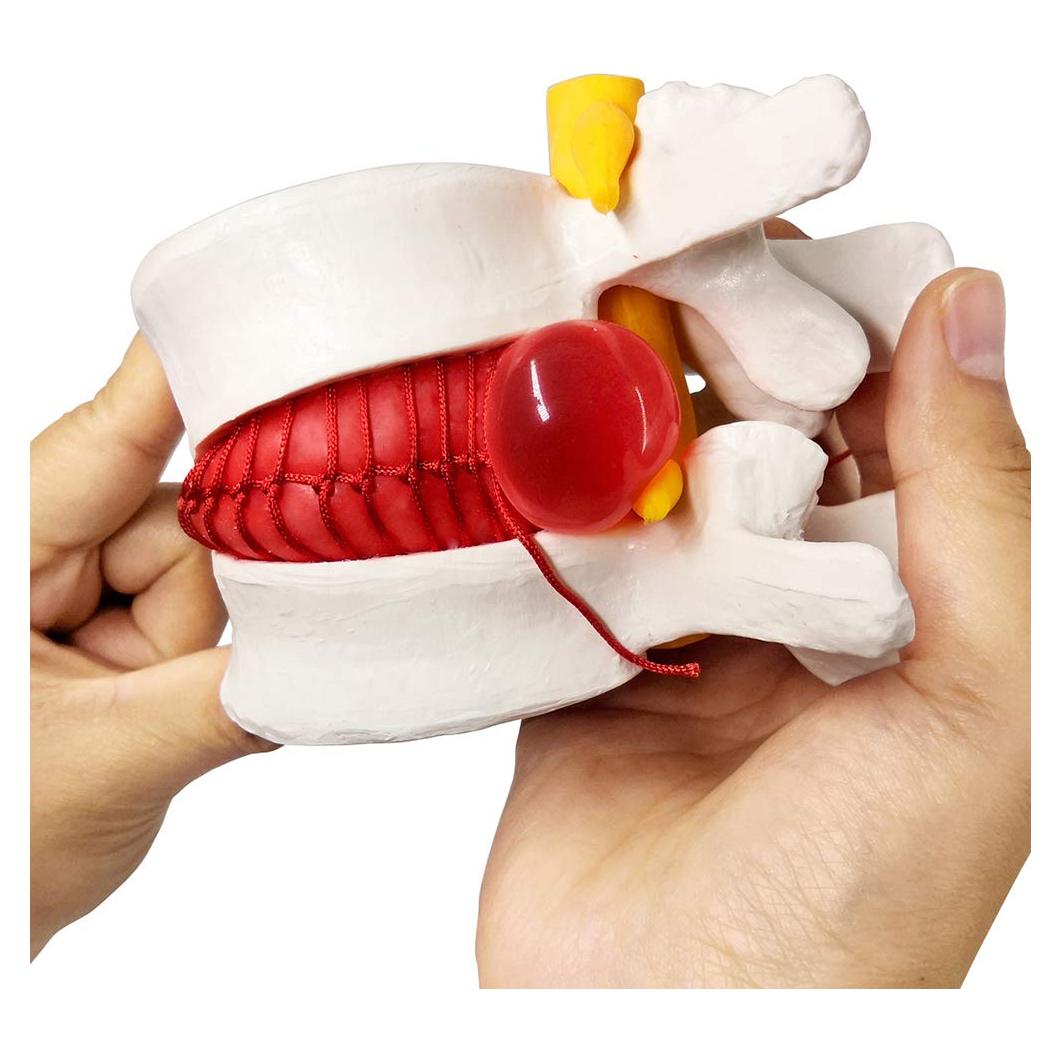 Modelo Anatómico de Disco Herniado Humano EVOTECH 13x12cm