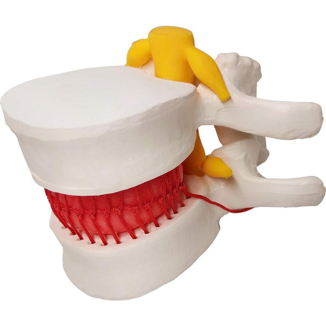 Modelo Anatómico de Disco Herniado Humano EVOTECH 13x12cm
