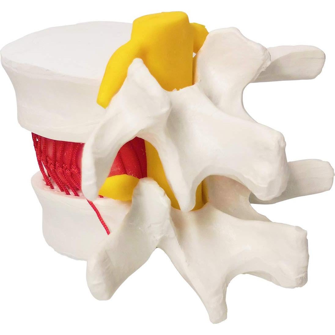 Modelo Anatómico de Disco Herniado Humano EVOTECH 13x12cm