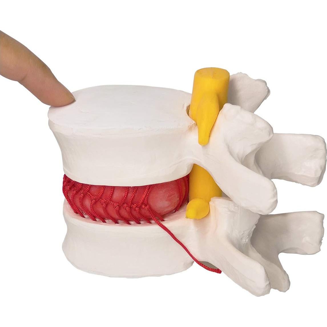 Modelo Anatómico de Disco Herniado Humano EVOTECH 13x12cm