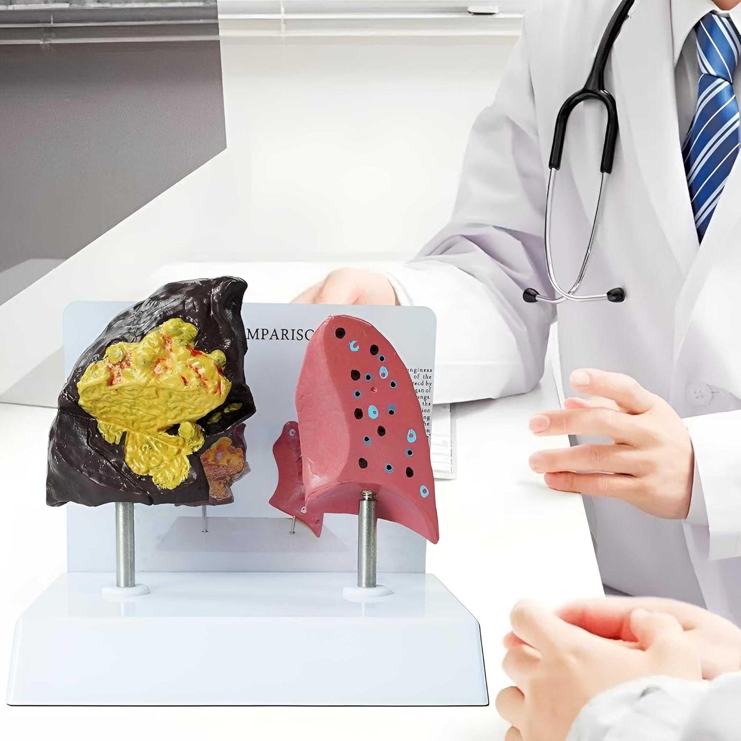 Modelo Anatómico de Pulmón Fumador vs Saludable PVC 21.96x13.99cm