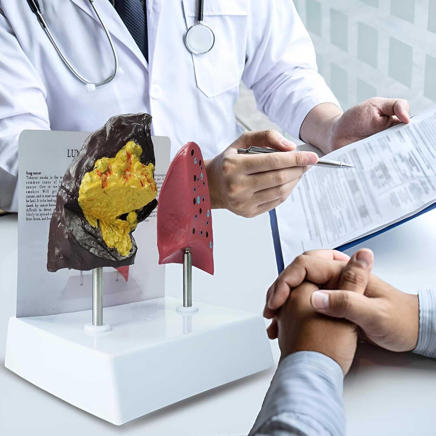 Modelo Anatómico de Pulmón Fumador vs Saludable PVC 21.96x13.99cm