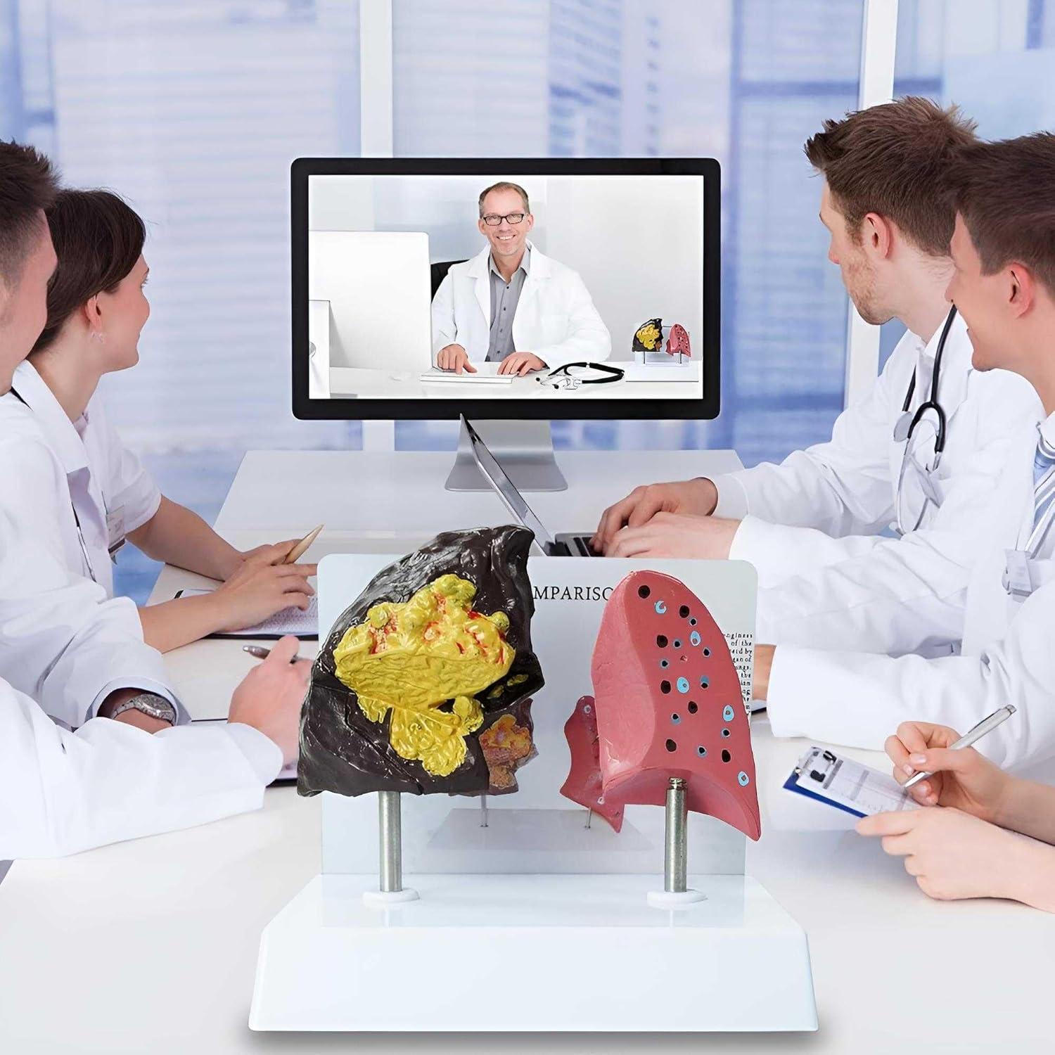 Modelo Anatómico de Pulmón Fumador vs Saludable PVC 21.96x13.99cm