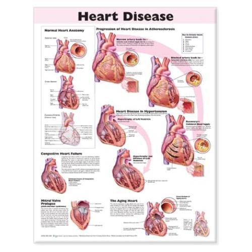 Heart Disease Anatomical Chart