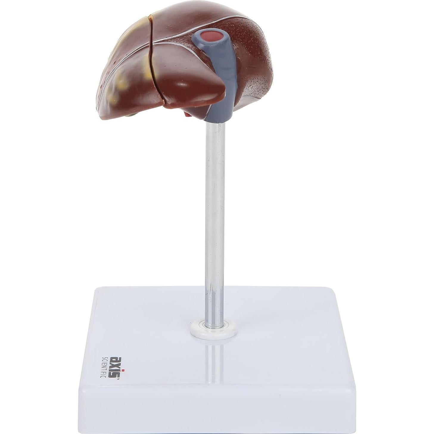 Axis Scientific Anatomy Model of Diseased Liver | Model is 1/3 Life-Size and Divides in 2 Parts | Shows 6 Liver Diseases and Abnormalities | Comes on a White Base