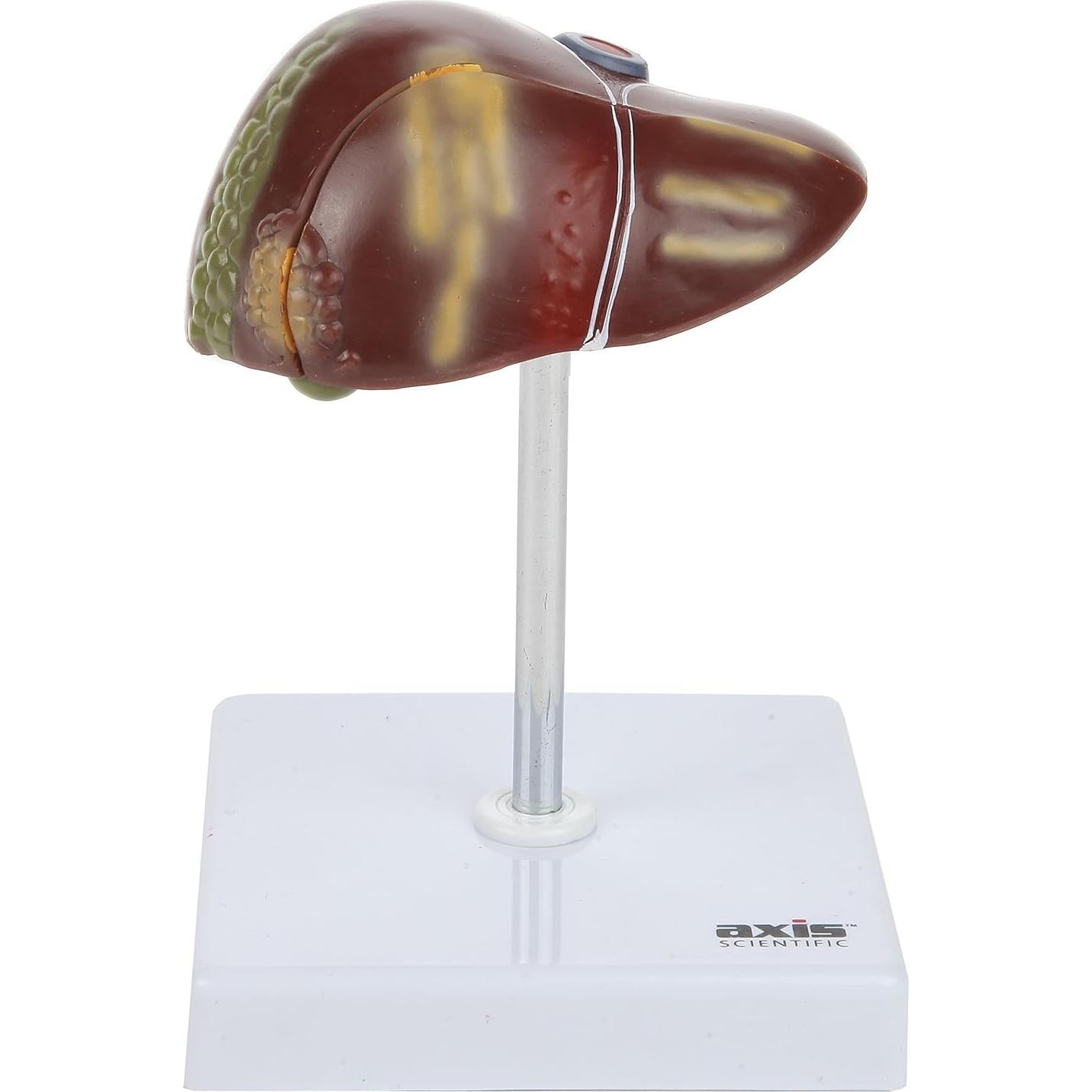 Axis Scientific Anatomy Model of Diseased Liver | Model is 1/3 Life-Size and Divides in 2 Parts | Shows 6 Liver Diseases and Abnormalities | Comes on a White Base