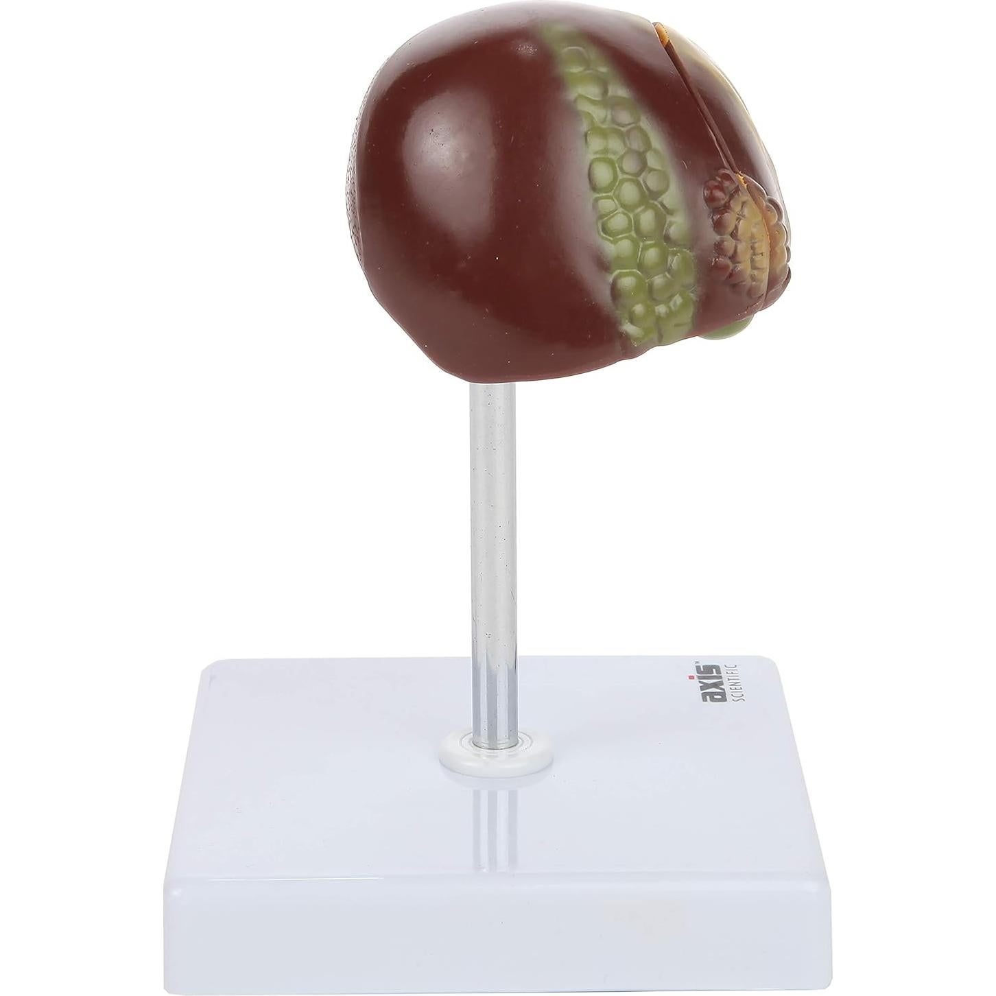 Axis Scientific Anatomy Model of Diseased Liver | Model is 1/3 Life-Size and Divides in 2 Parts | Shows 6 Liver Diseases and Abnormalities | Comes on a White Base