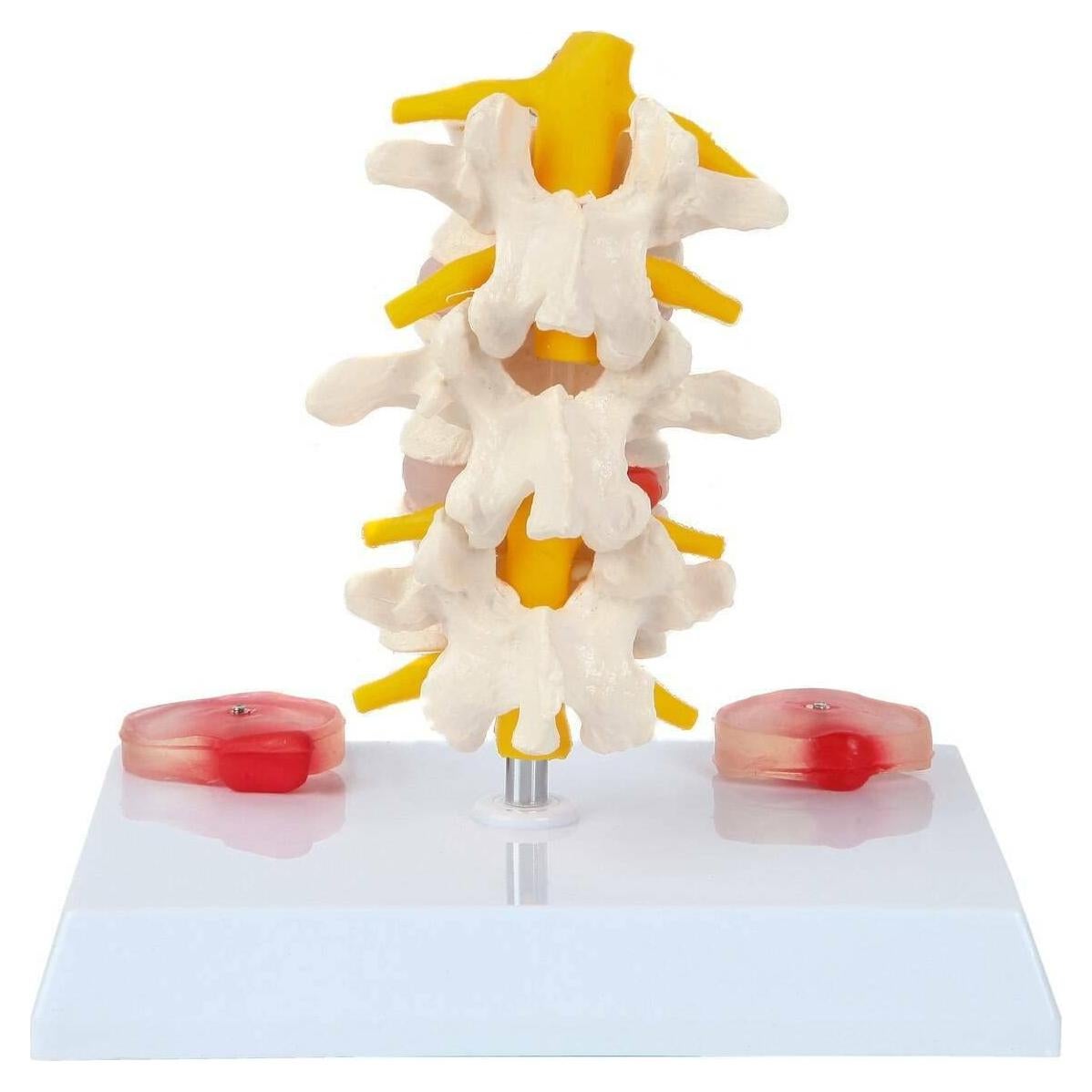 Modelo de Vérttebras Lumbar Axis Scientific con Discos Prolapsados