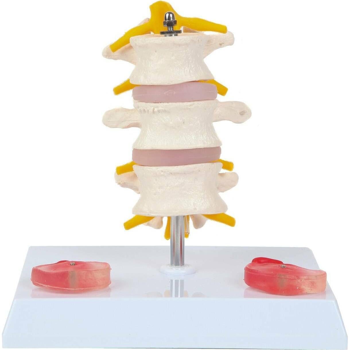 Modelo de Vérttebras Lumbar Axis Scientific con Discos Prolapsados