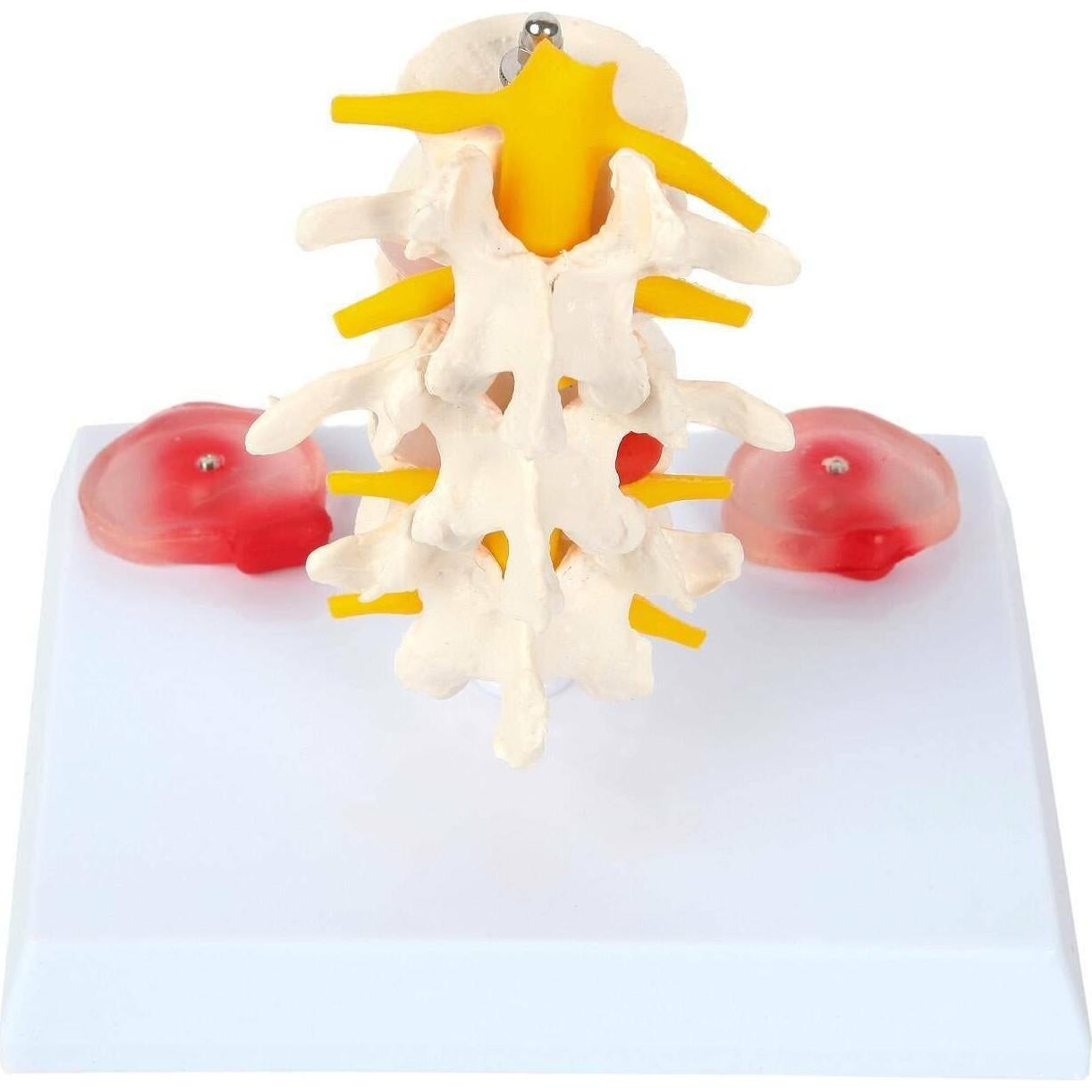 Modelo de Vérttebras Lumbar Axis Scientific con Discos Prolapsados
