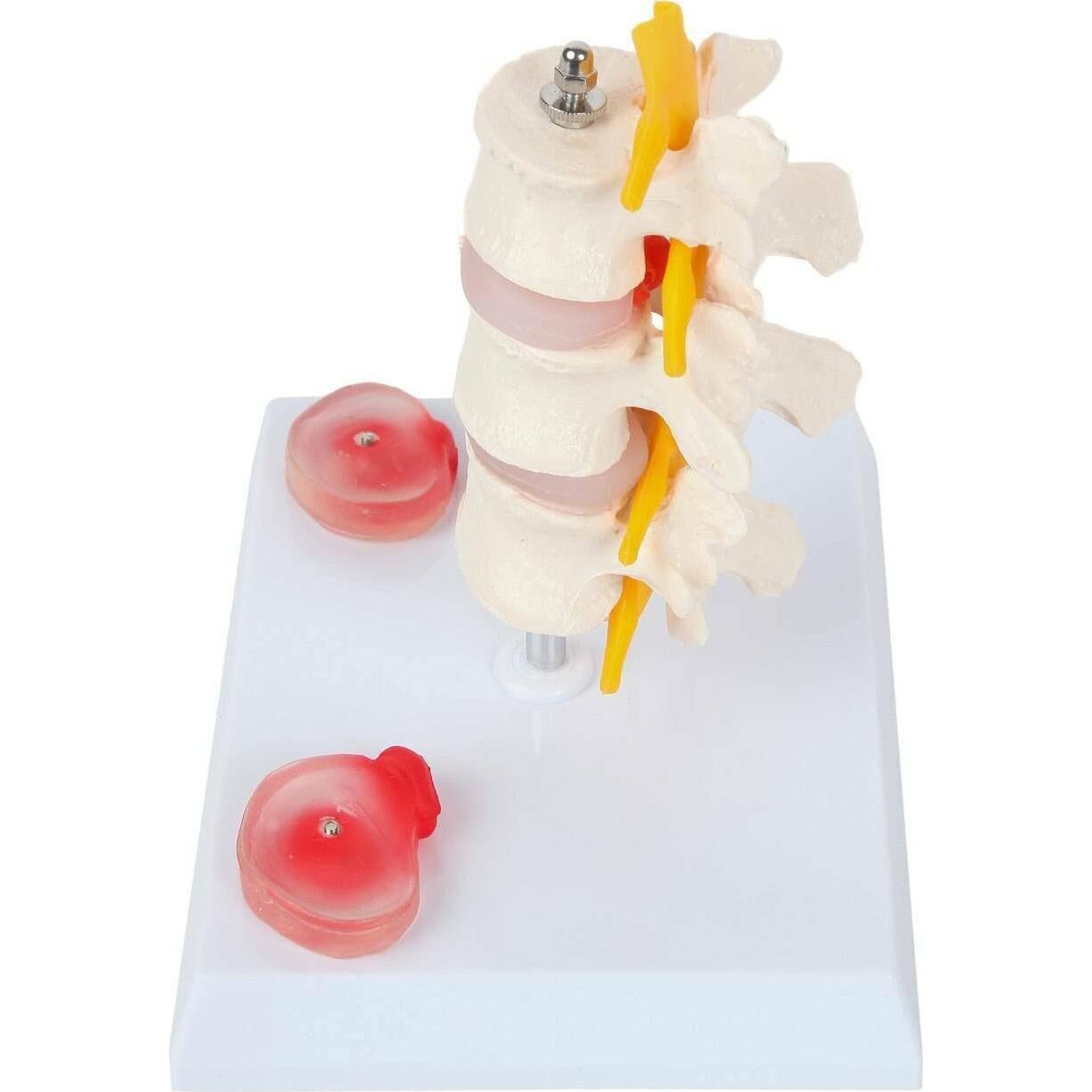 Modelo de Vérttebras Lumbar Axis Scientific con Discos Prolapsados