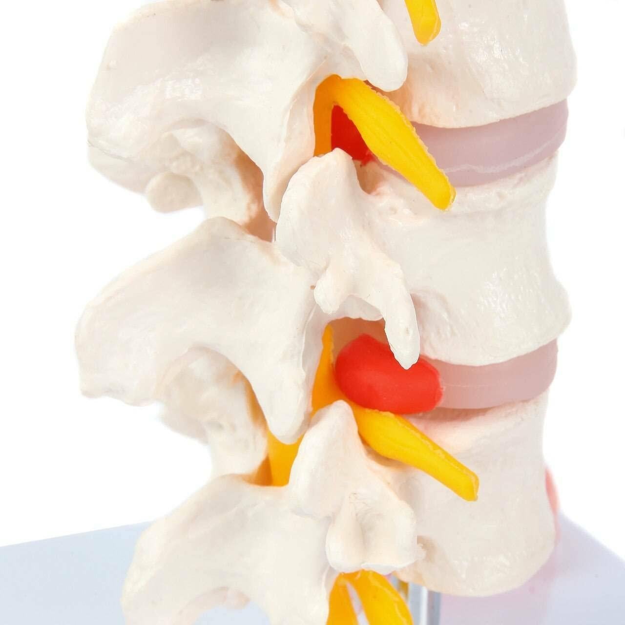 Modelo de Vérttebras Lumbar Axis Scientific con Discos Prolapsados