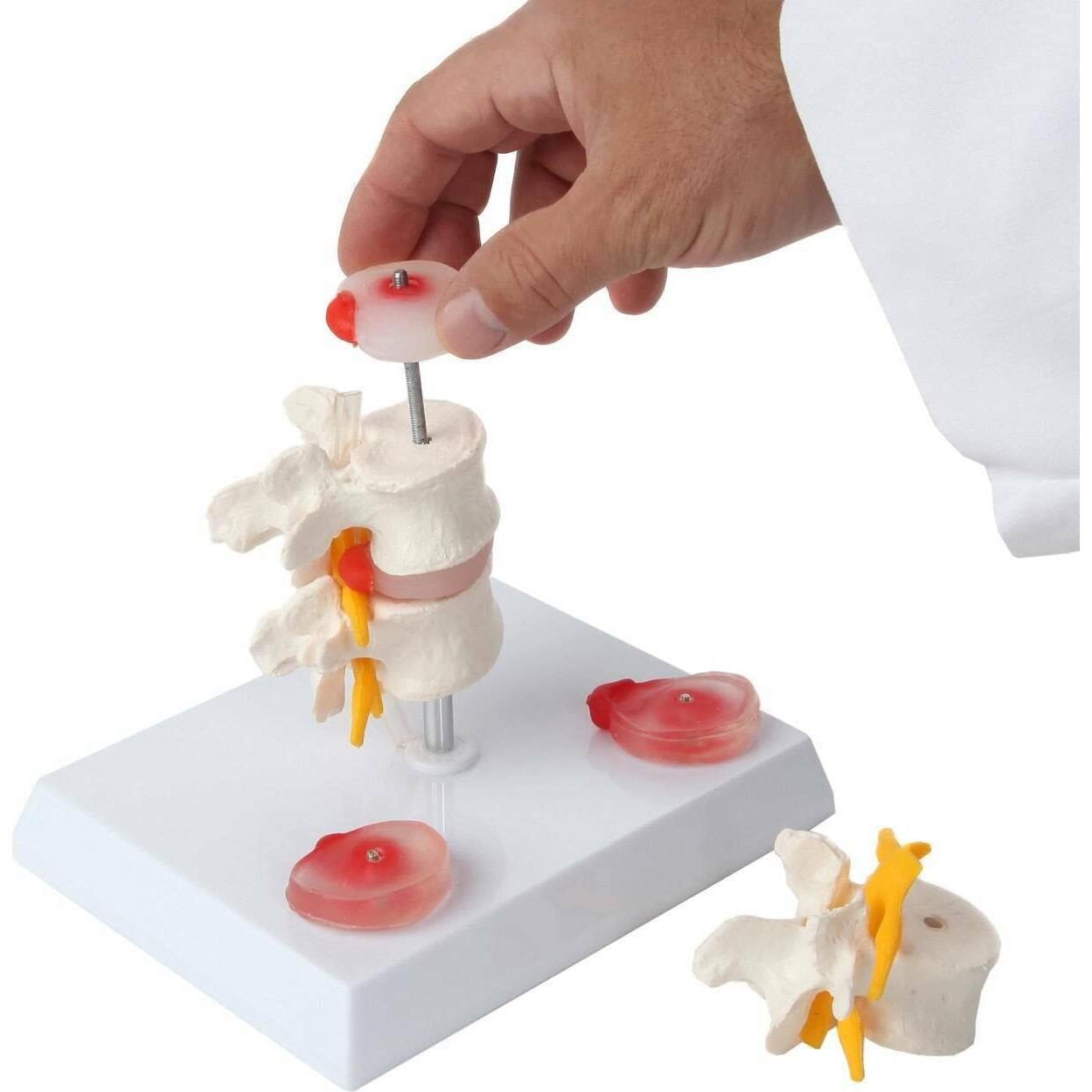 Modelo de Vérttebras Lumbar Axis Scientific con Discos Prolapsados