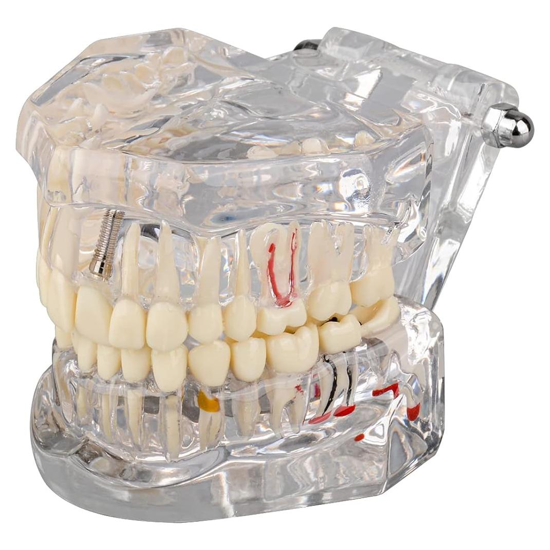 Modelo Dental Patológico Transparente Ultrassist 6.5x8.9cm