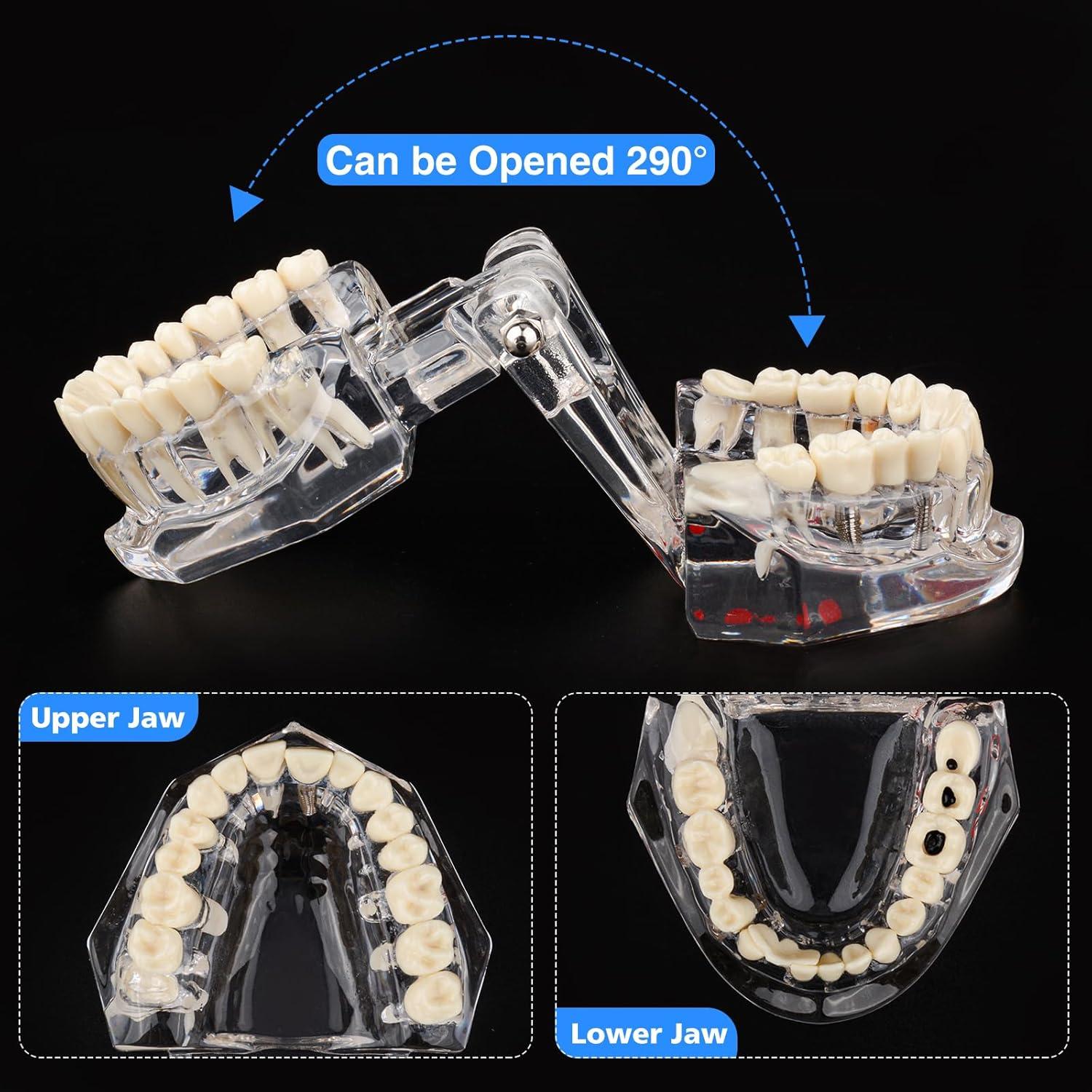 Modelo Dental Patológico Transparente Ultrassist 6.5x8.9cm