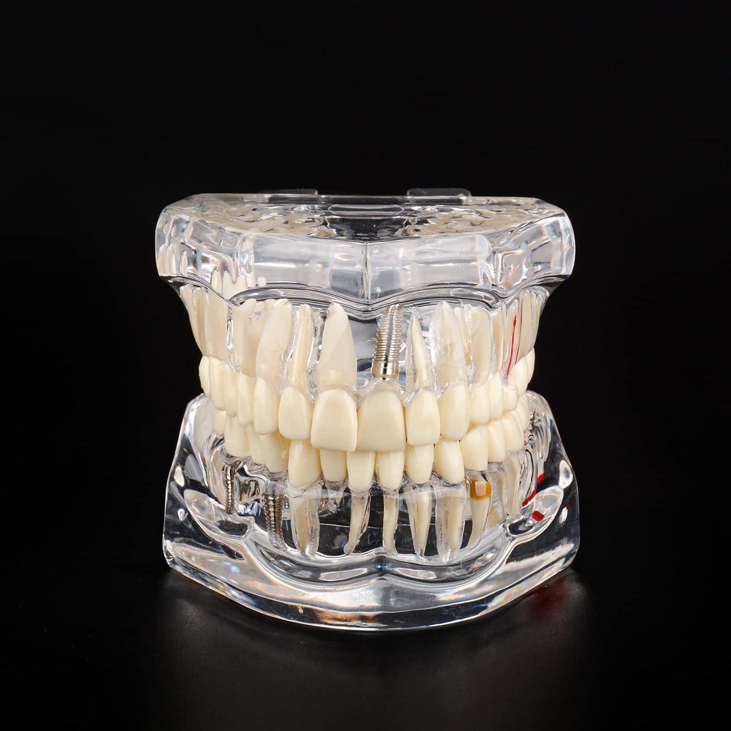 Modelo Dental Patológico Transparente Ultrassist 6.5x8.9cm
