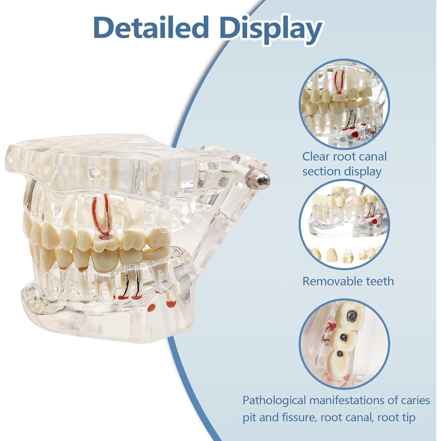 Modelo Dental Transparente Windplusya con Puente e Implantes