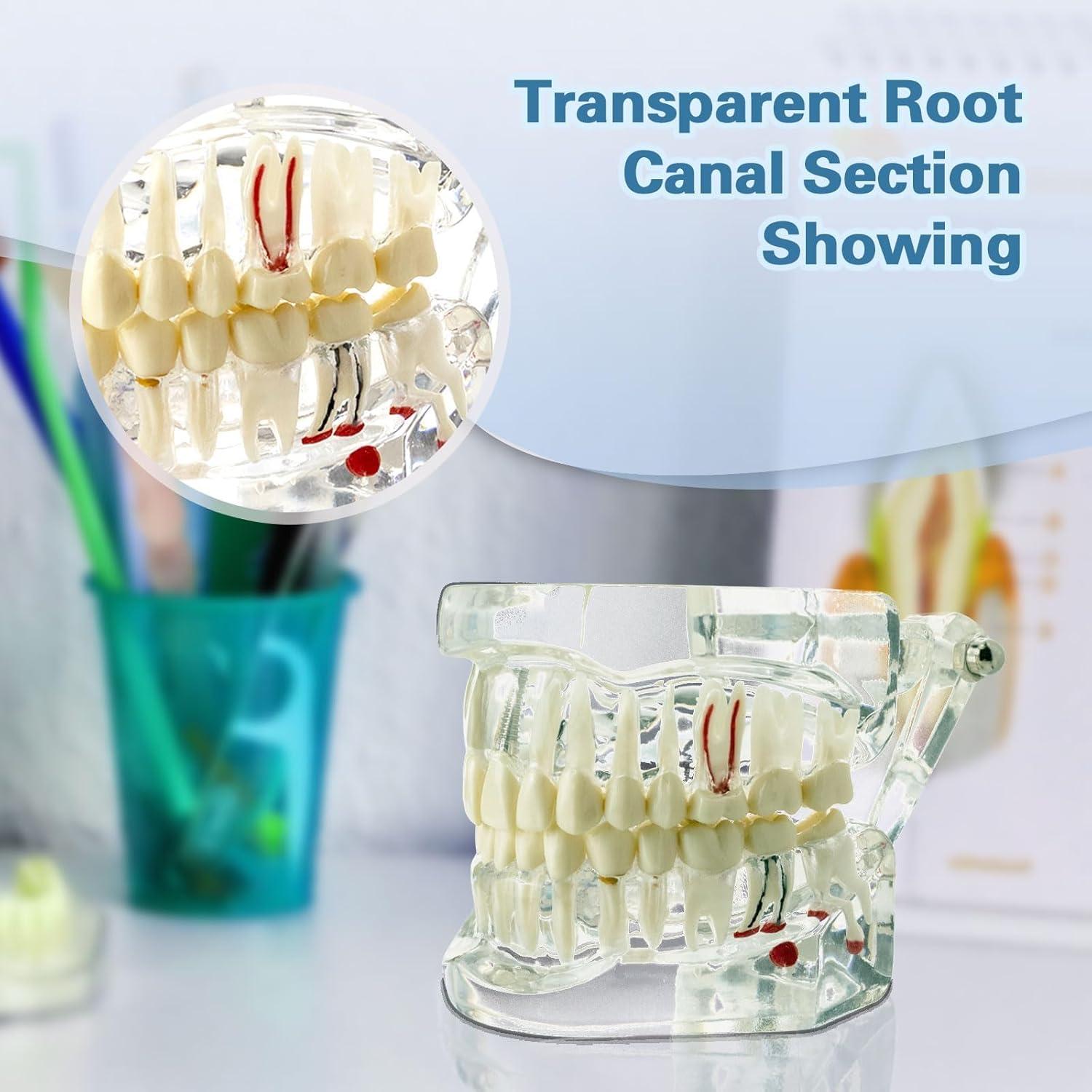 Modelo Dental Transparente Windplusya con Puente e Implantes