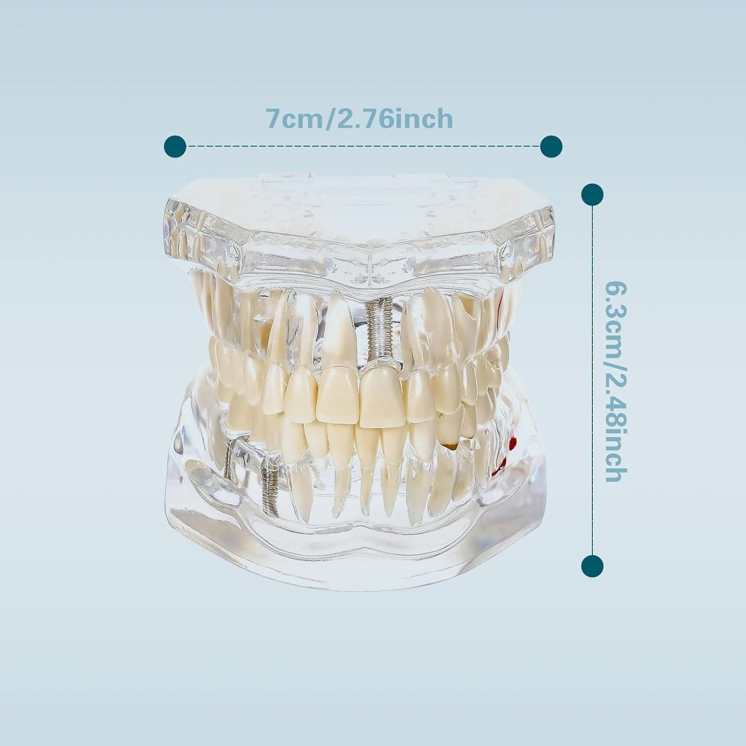 Modelo Dental Transparente Windplusya con Puente e Implantes