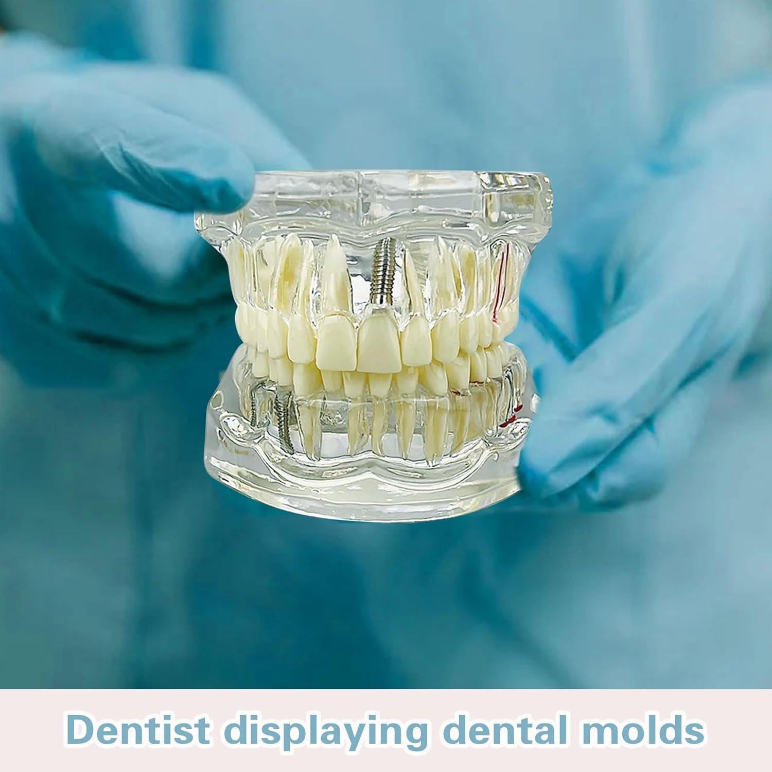 Modelo Dental Transparente Windplusya con Puente e Implantes