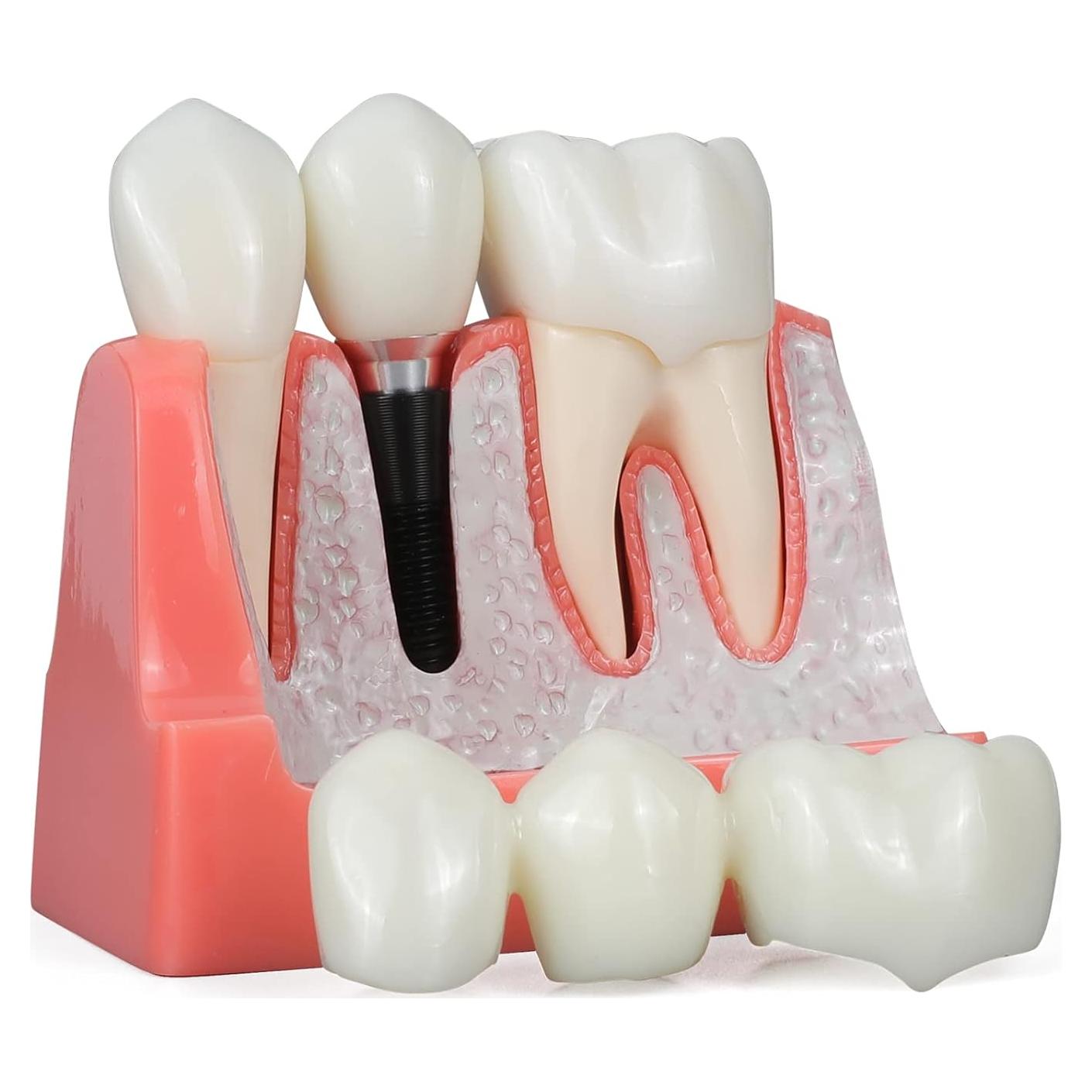 Modelo de Implante Dental ANNWAN 4 Veces Removible para Educación