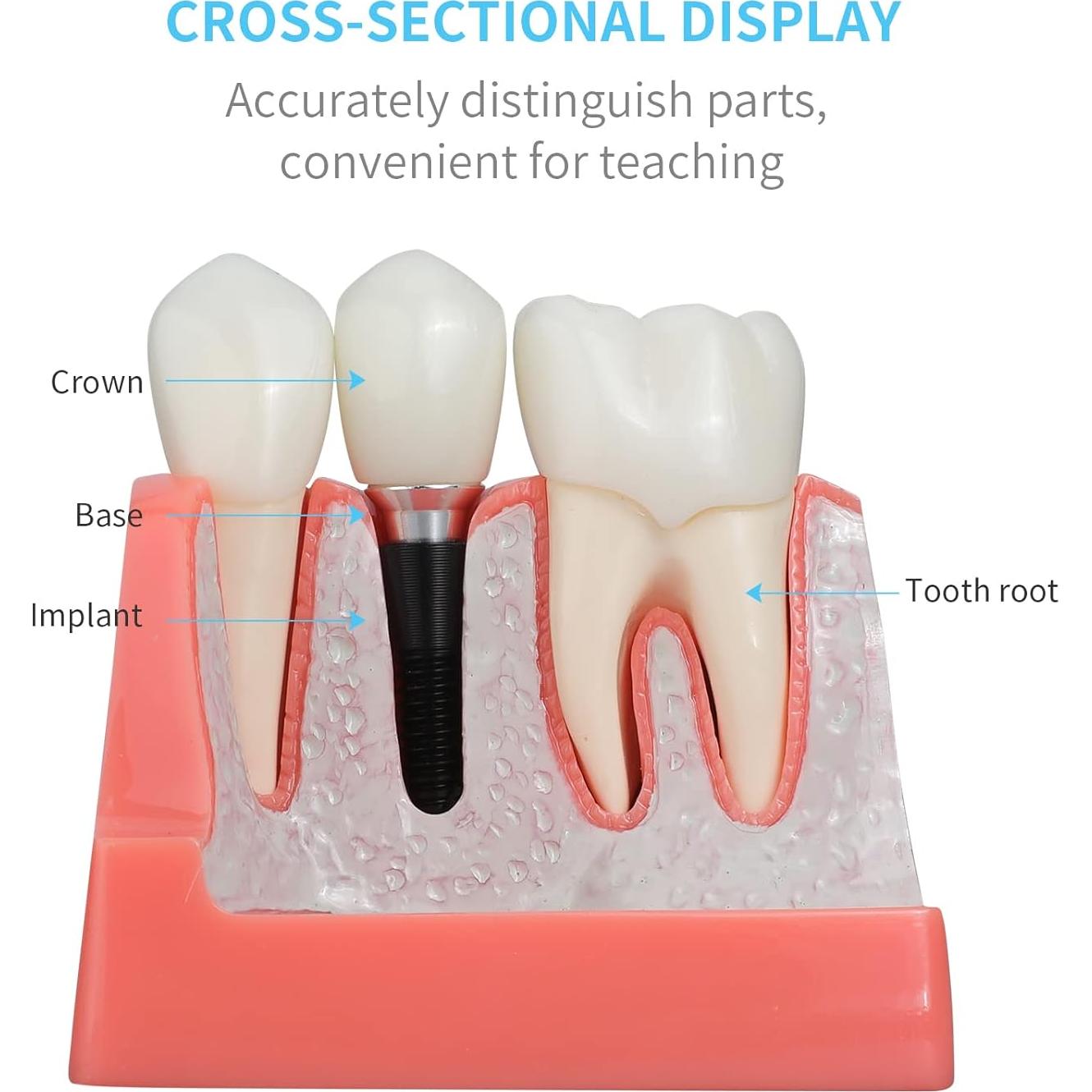 Modelo de Implante Dental ANNWAN 4 Veces Removible para Educación