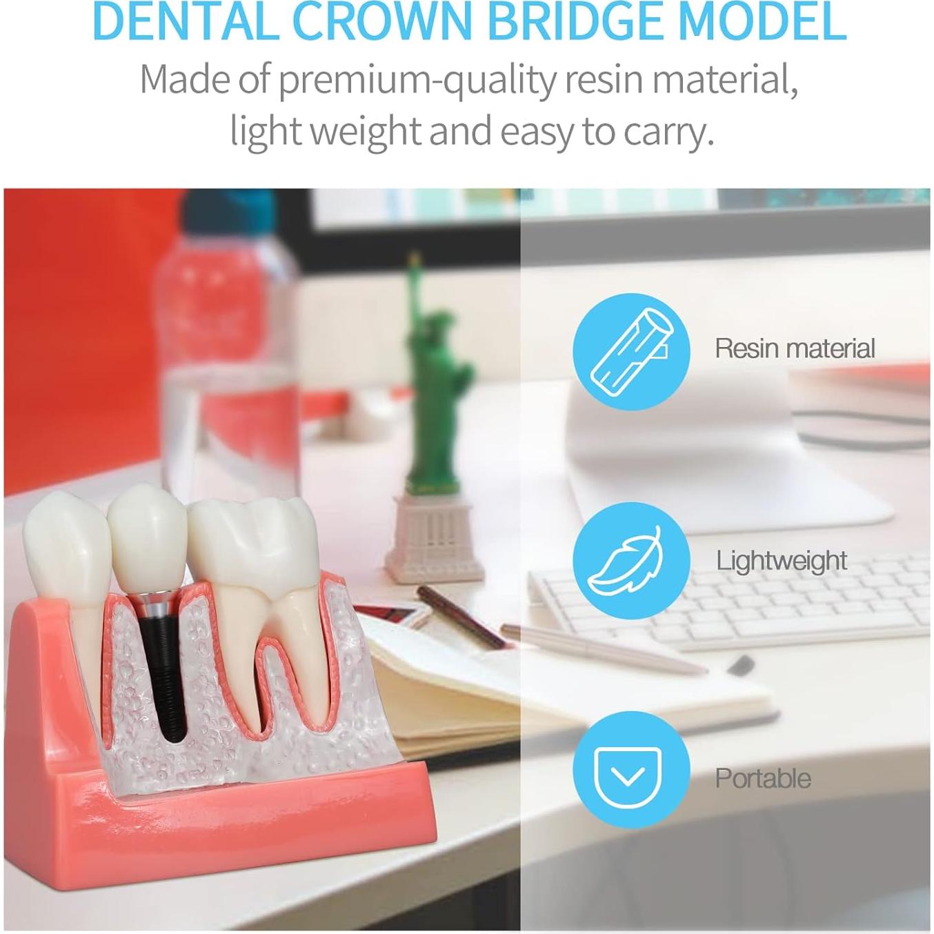 Modelo de Implante Dental ANNWAN 4 Veces Removible para Educación