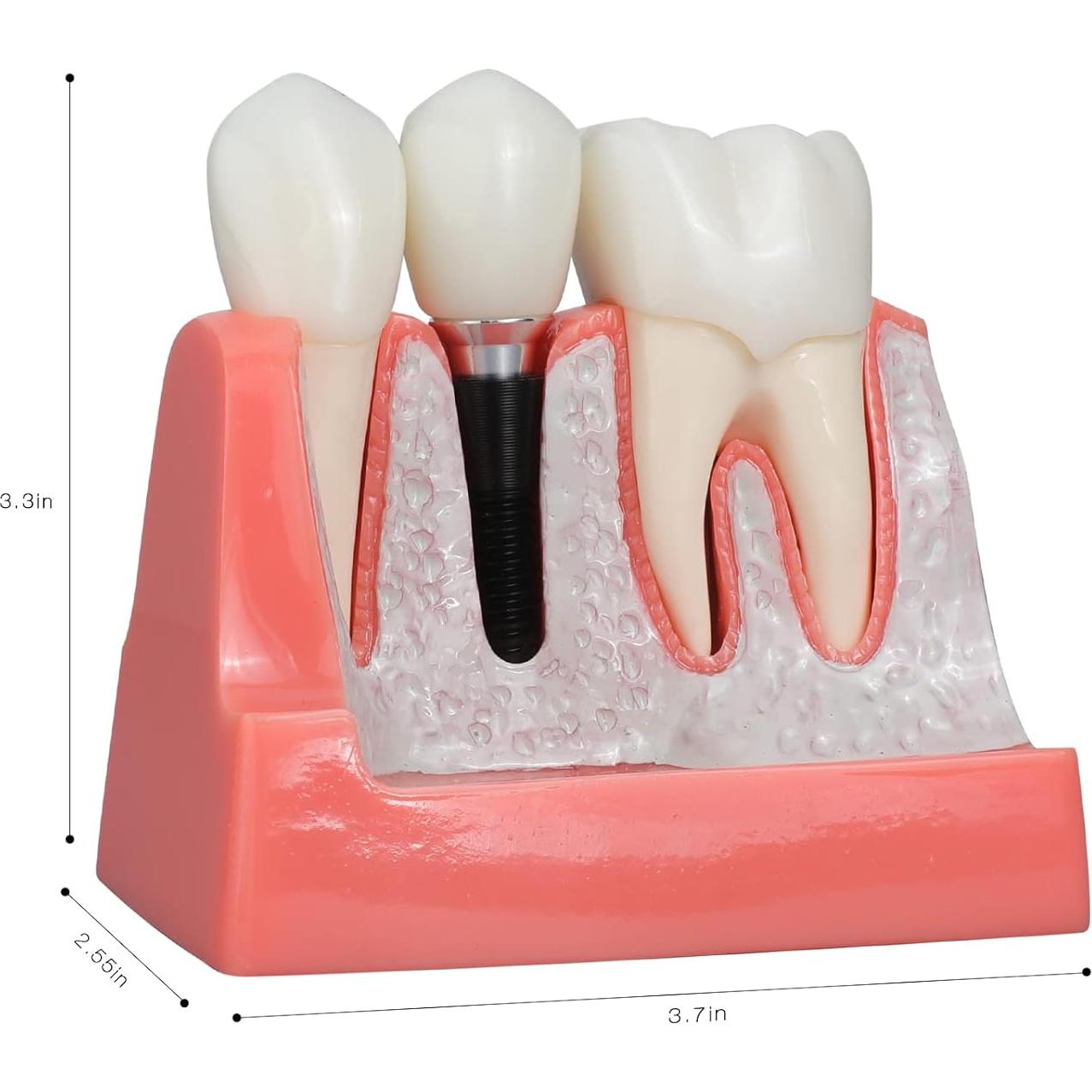 Modelo de Implante Dental ANNWAN 4 Veces Removible para Educación