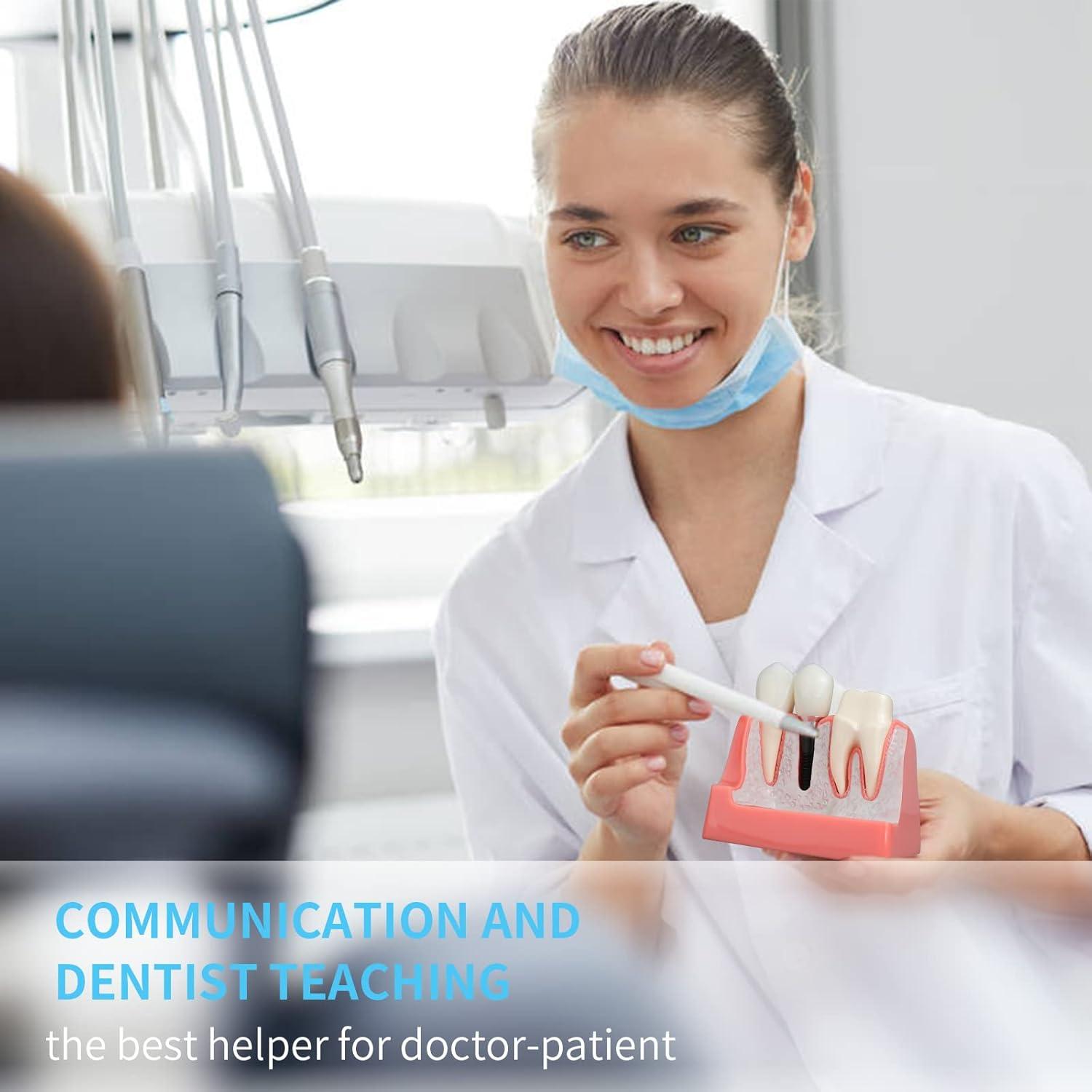 Modelo de Implante Dental ANNWAN 4 Veces Removible para Educación