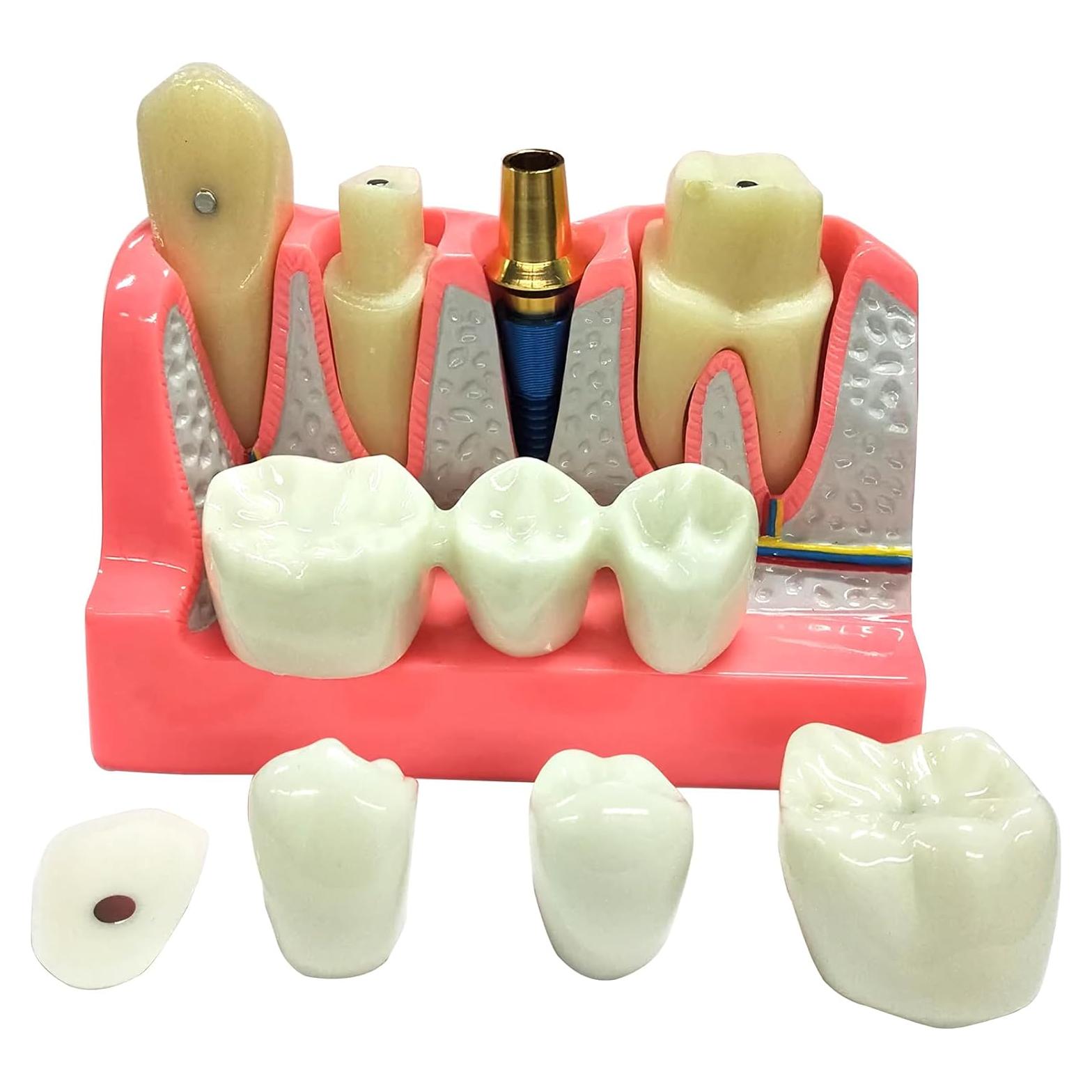 Modelo de Implante Dental 4 Dientes con Puente Removible