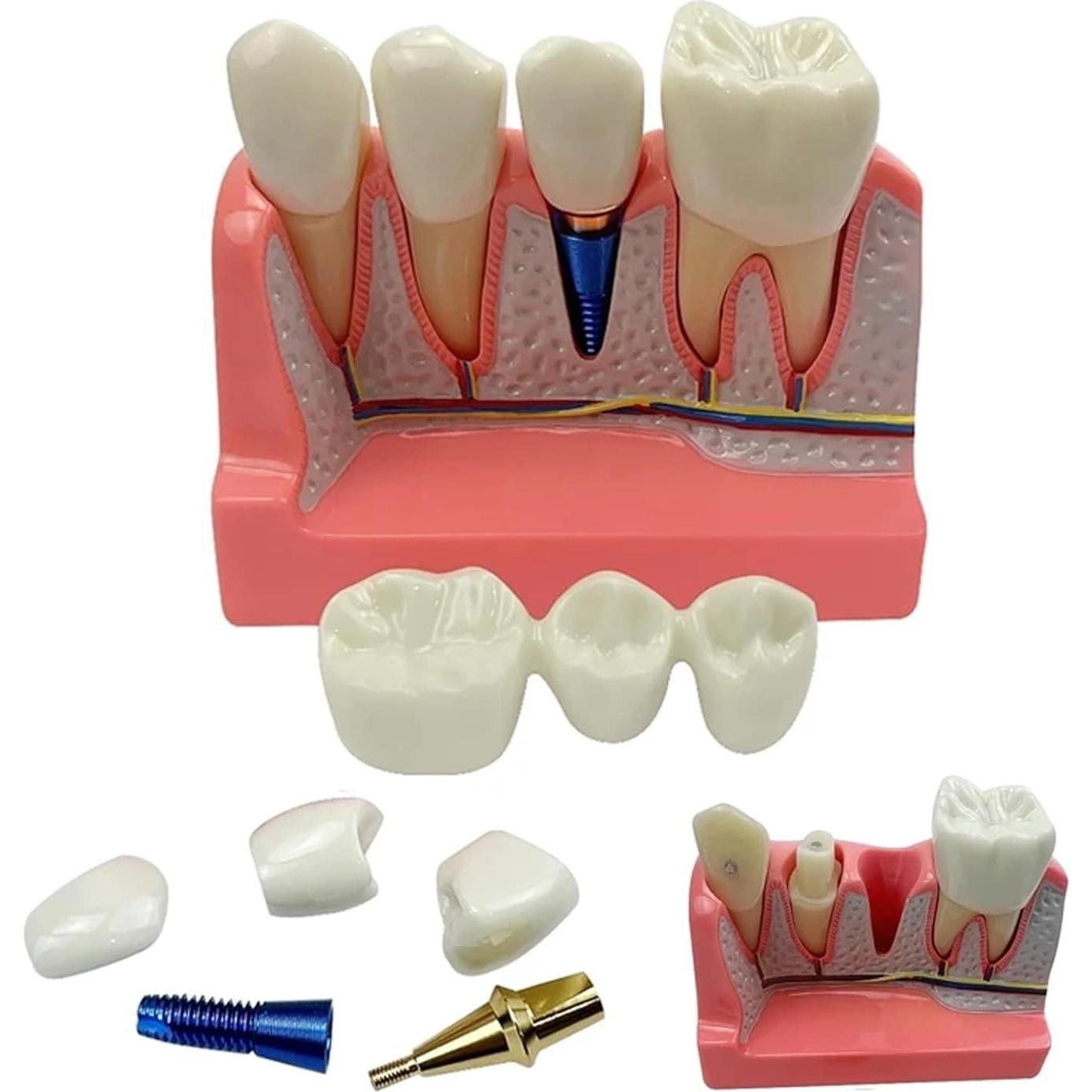 Modelo de Implante Dental 4 Dientes con Puente Removible