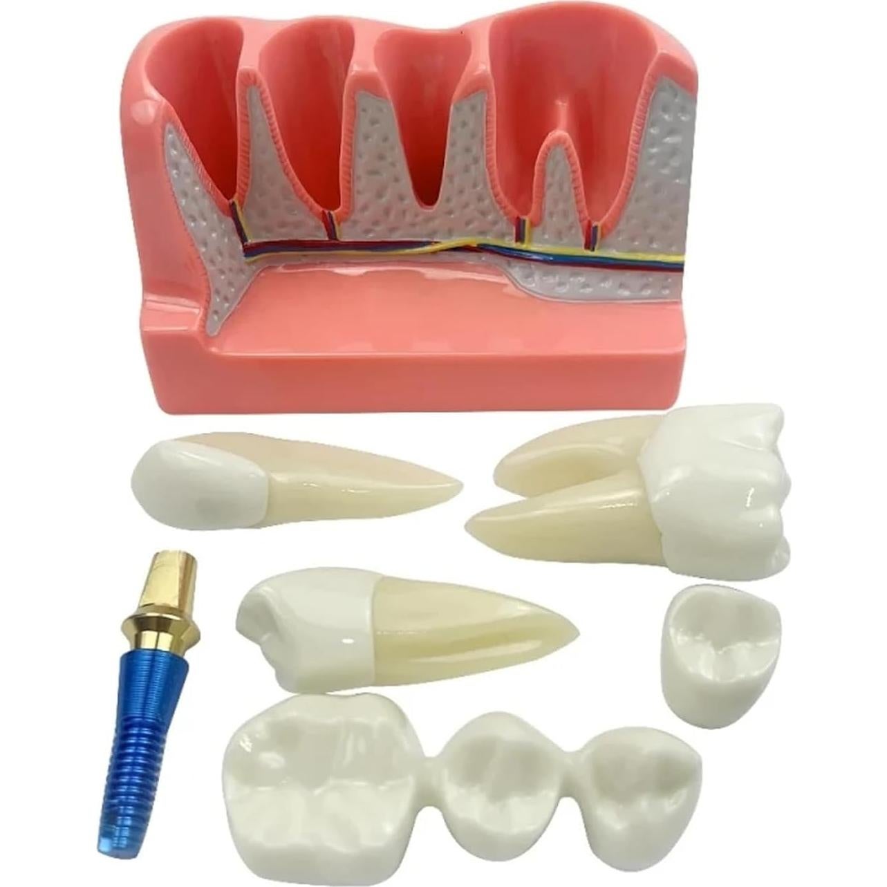 Modelo de Implante Dental 4 Dientes con Puente Removible