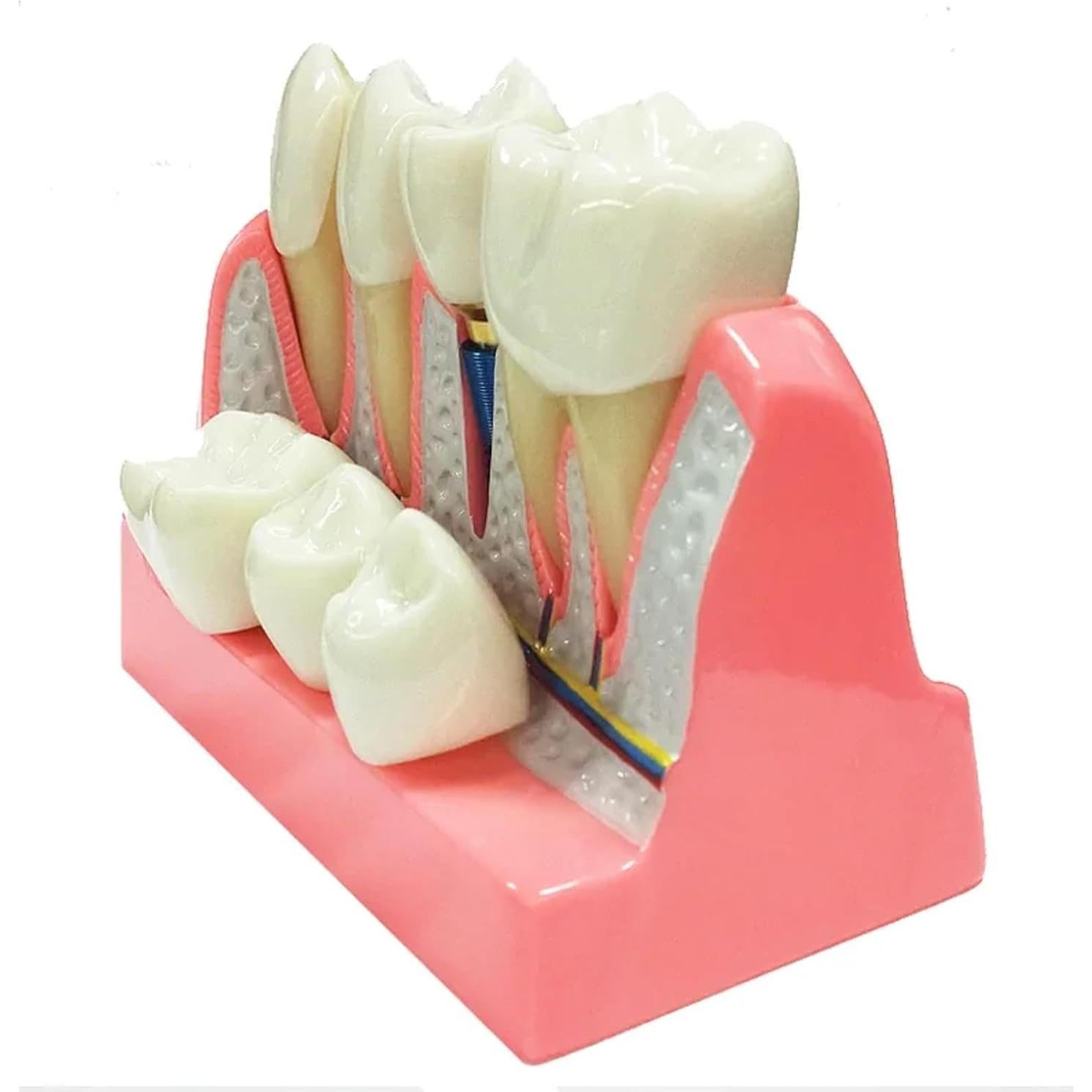 Modelo de Implante Dental 4 Dientes con Puente Removible